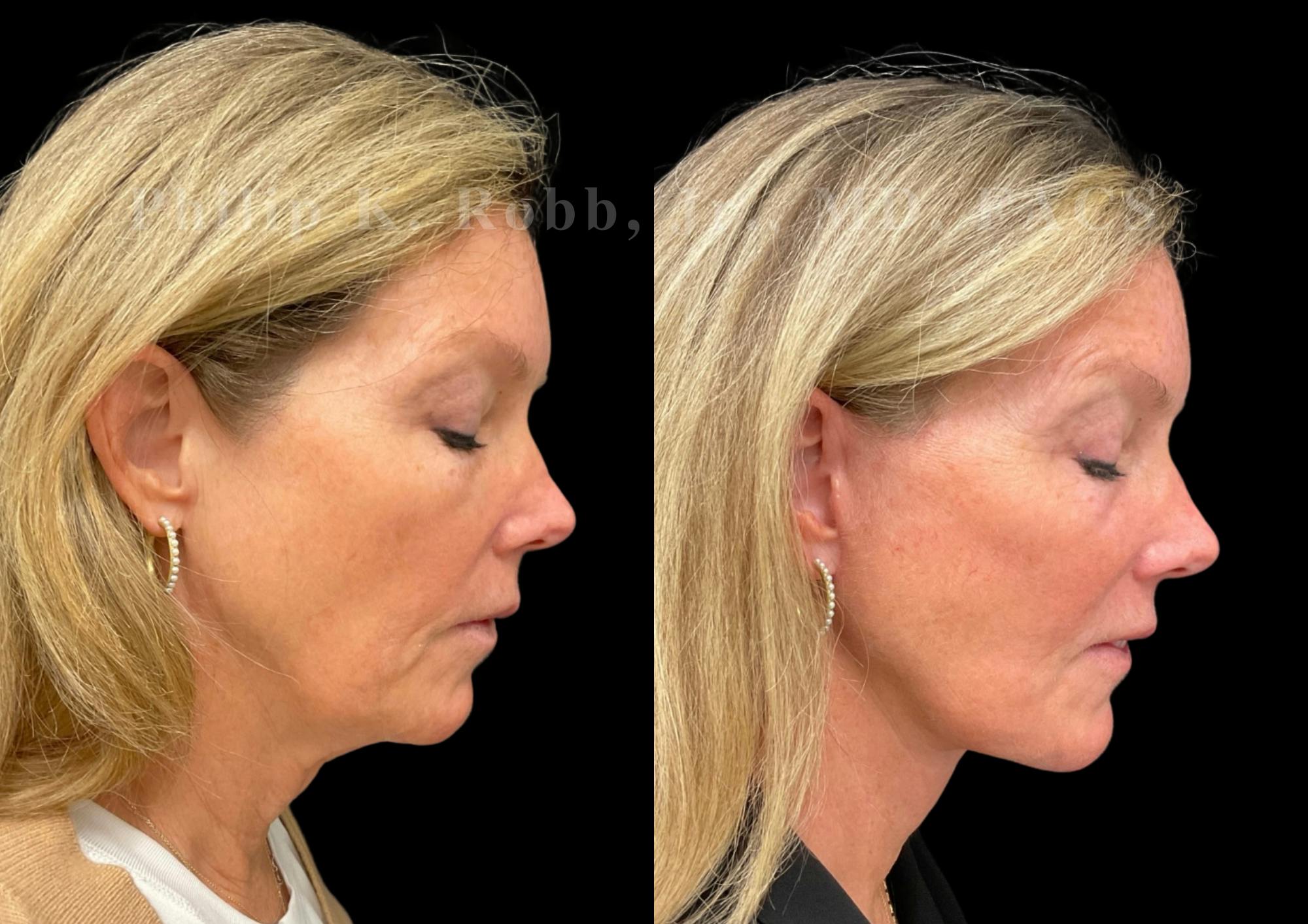 Brow Lift Before & After Gallery - Patient 397690 - Image 7