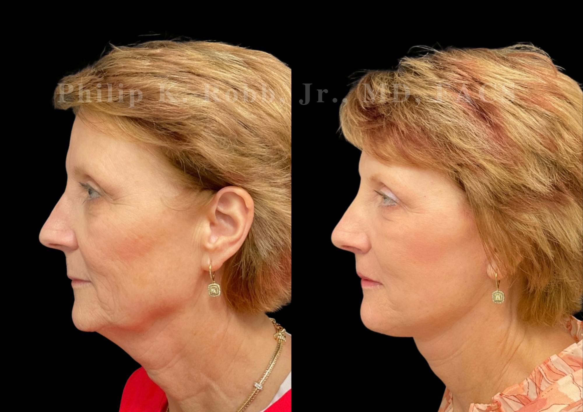 Neck Lift Before & After Gallery - Patient 303629 - Image 1
