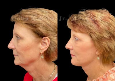 Neck Lift Before & After Gallery - Patient 303629 - Image 1