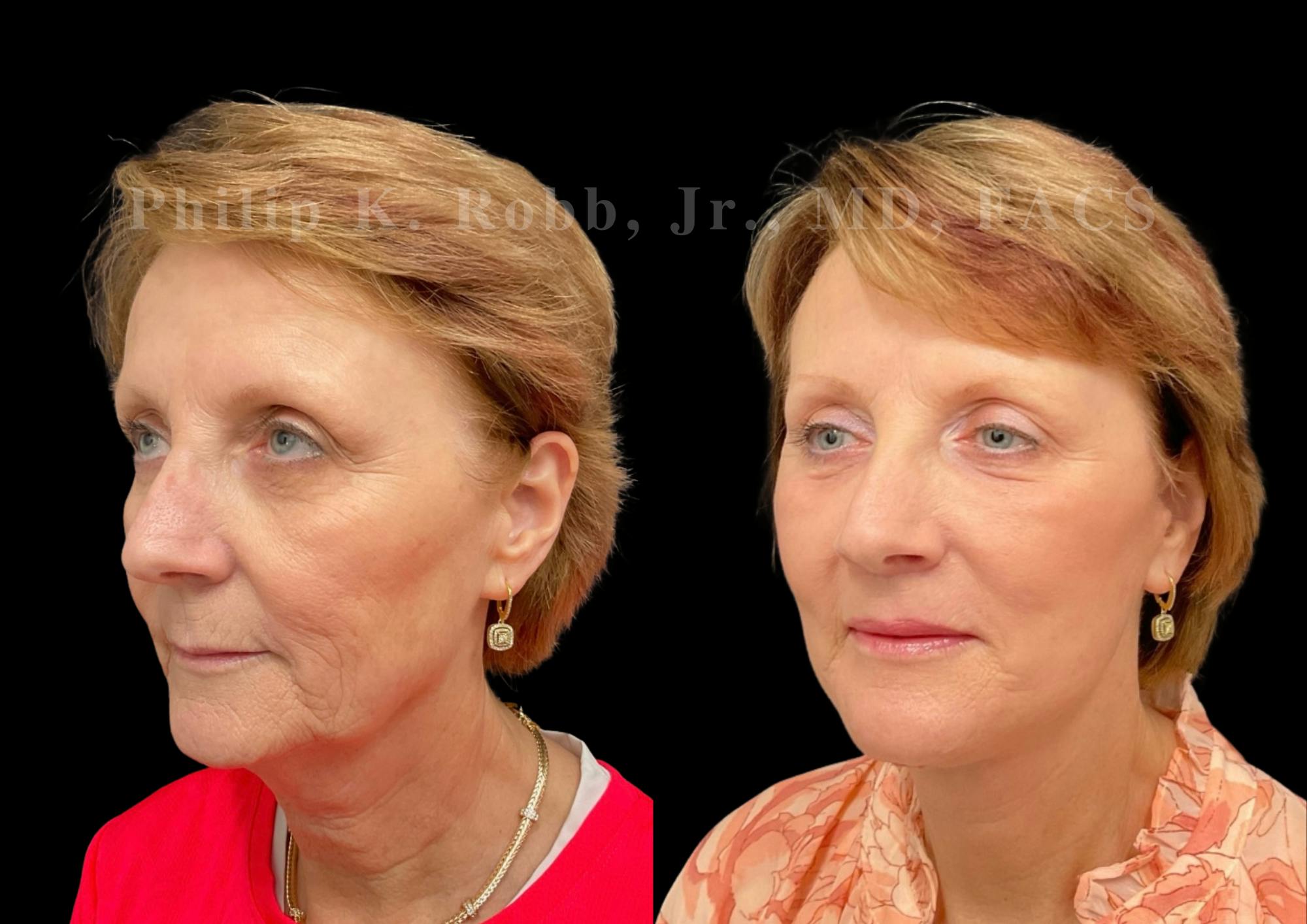 Neck Lift Before & After Gallery - Patient 303629 - Image 3