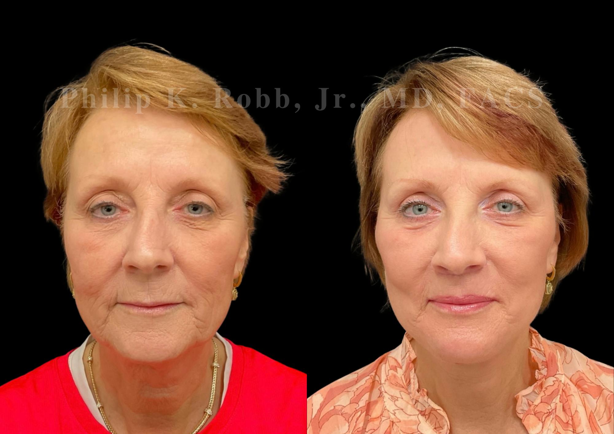 Neck Lift Before & After Gallery - Patient 303629 - Image 4