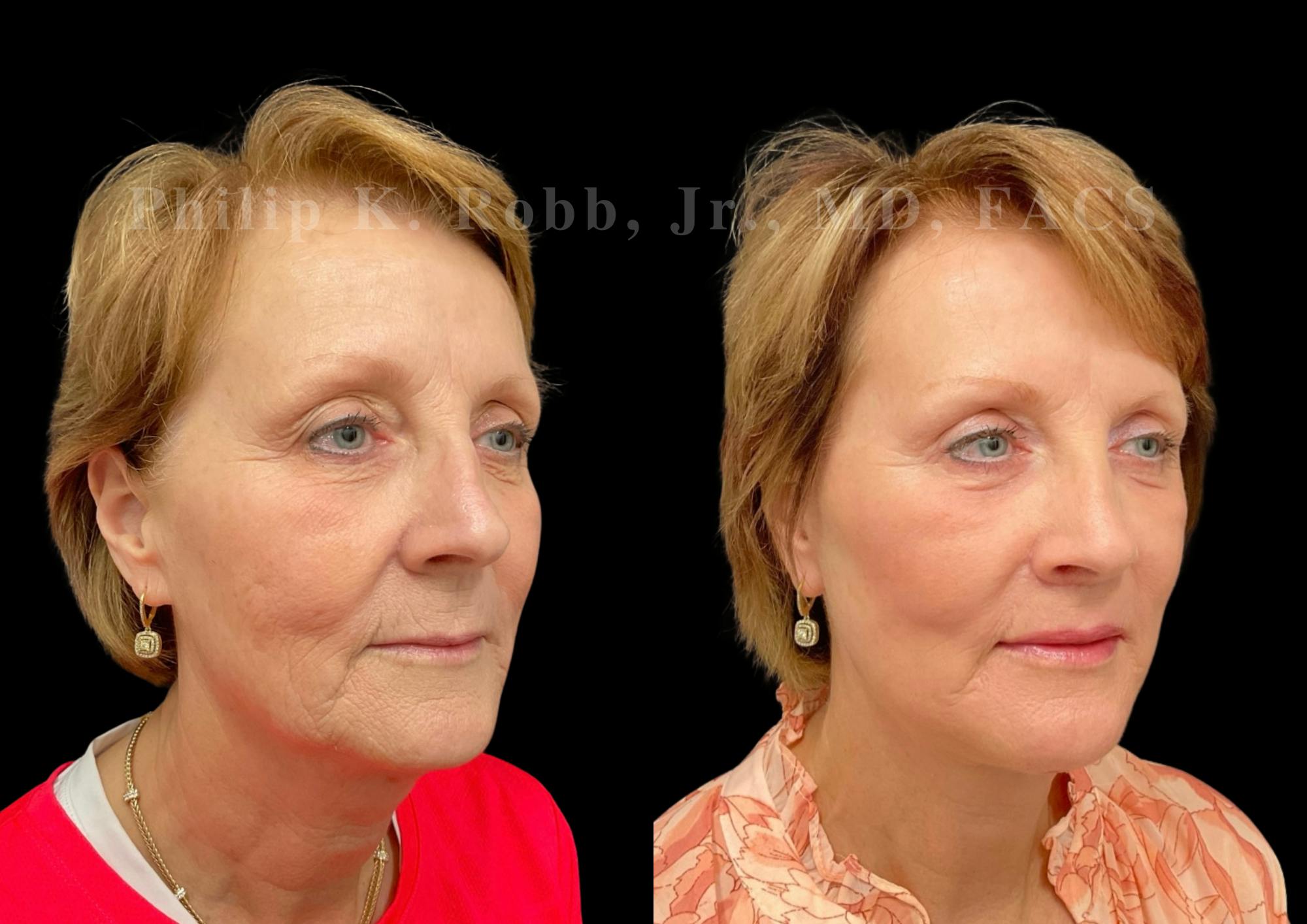 Neck Lift Before & After Gallery - Patient 303629 - Image 5