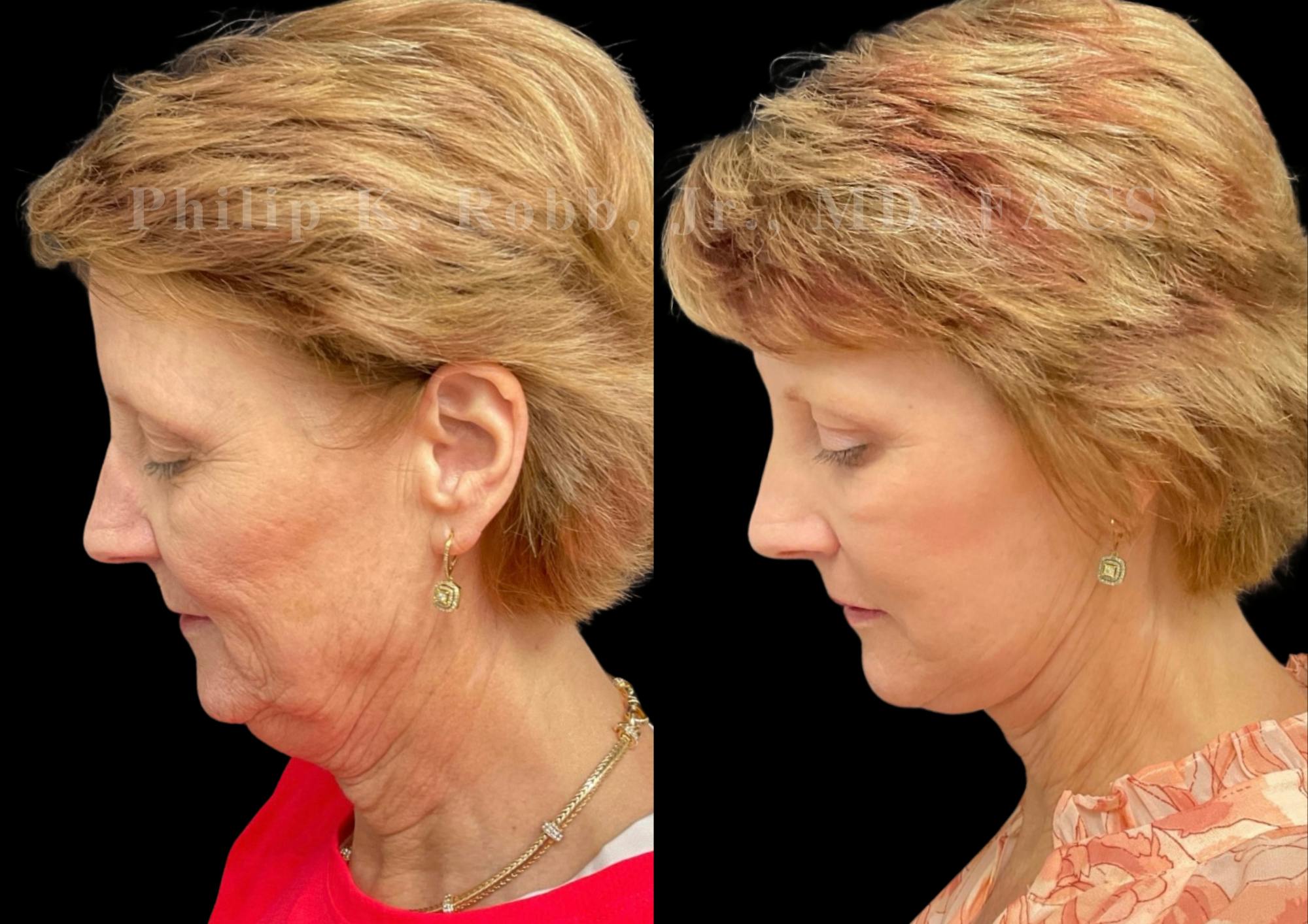 Neck Lift Before & After Gallery - Patient 303629 - Image 2