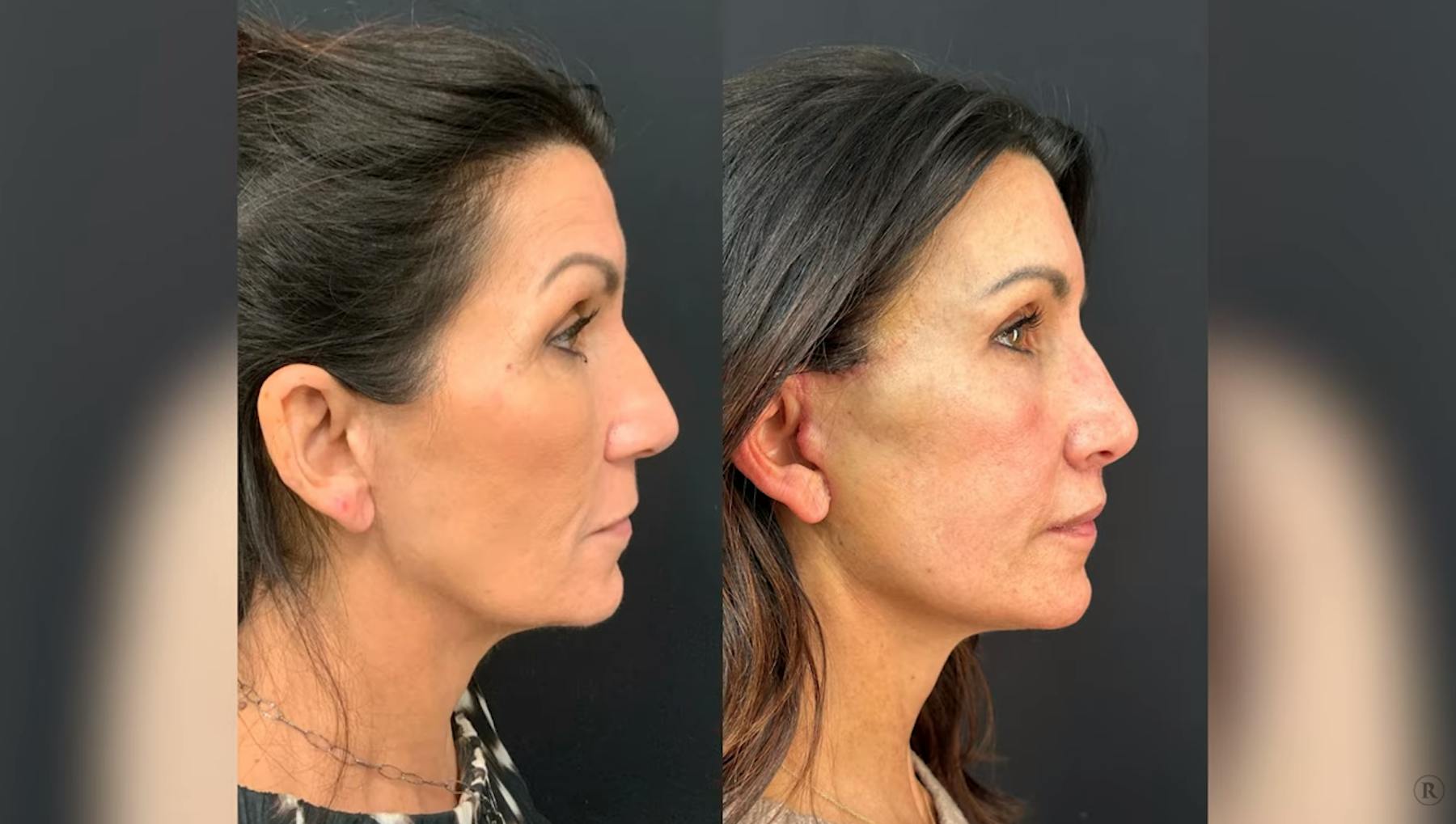 Robb Facial Plastic Surgery