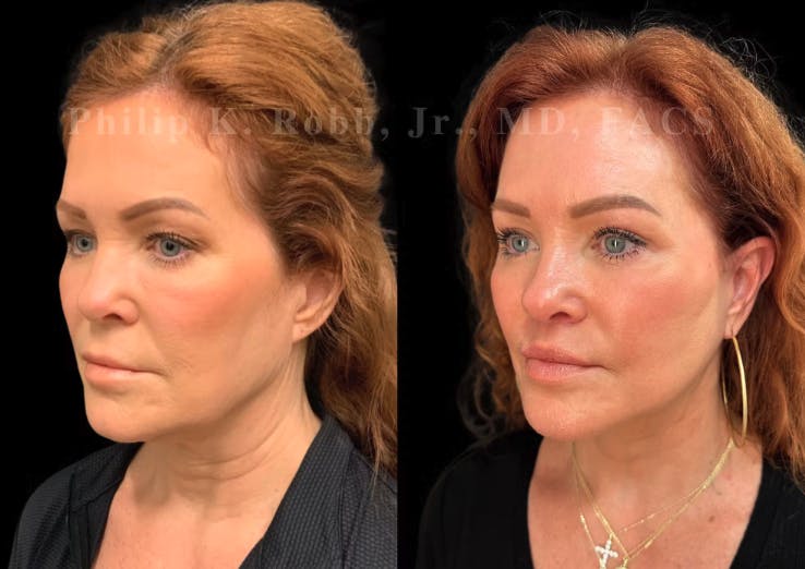 Dr.Robb facelift patient