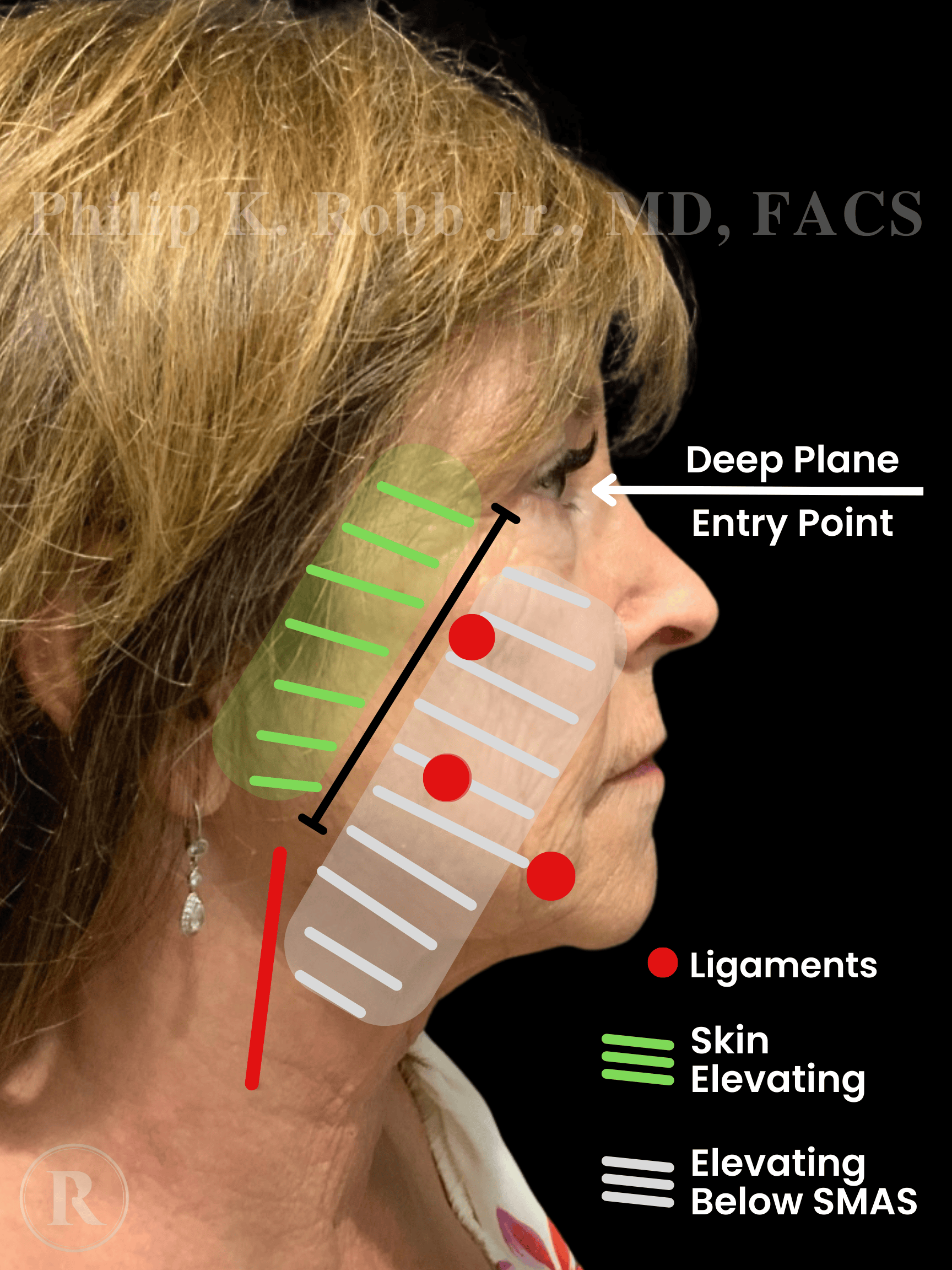 a diagram draw on a patients face to show what happens to the skin during a facelift