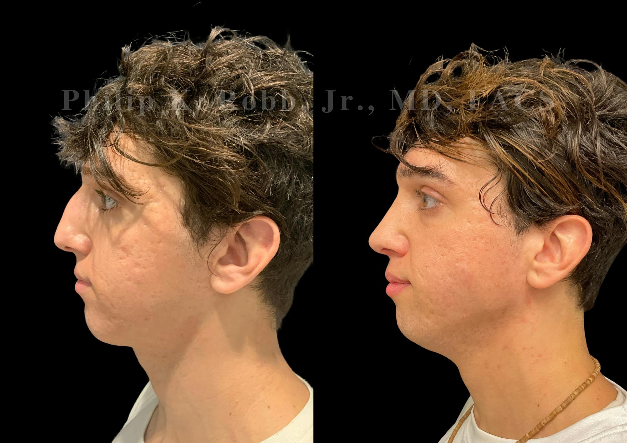 Ultrasonic Rhinoplasty Before & After Gallery - Patient 230223 - Image 5