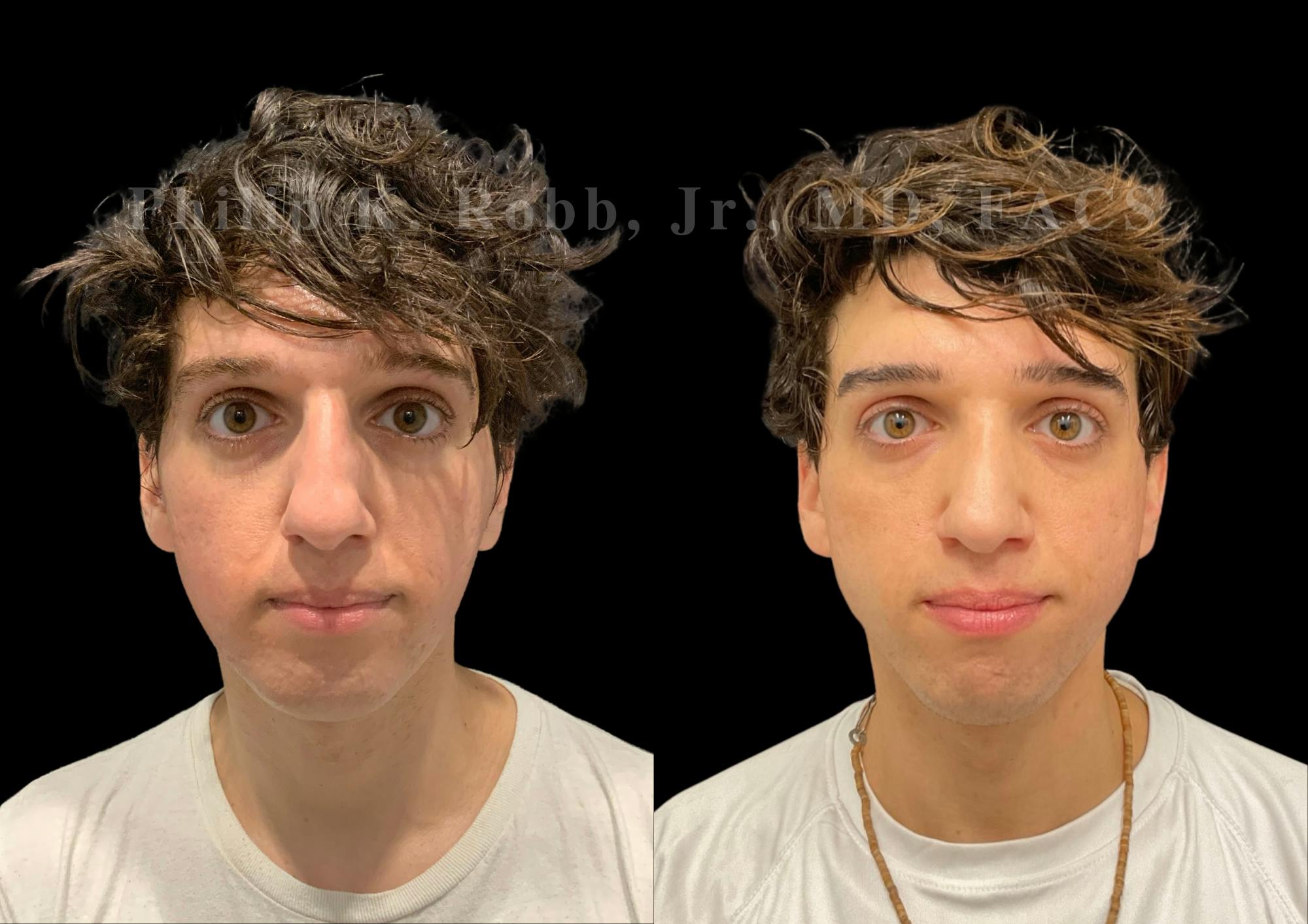 Ultrasonic Rhinoplasty Before & After Gallery - Patient 230223 - Image 3