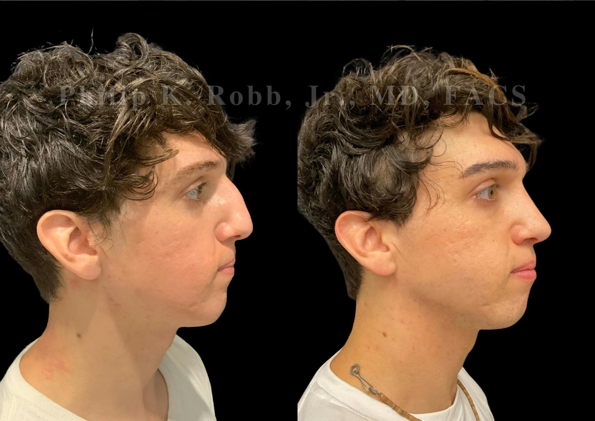 Ultrasonic Rhinoplasty Before & After Gallery - Patient 230223 - Image 1