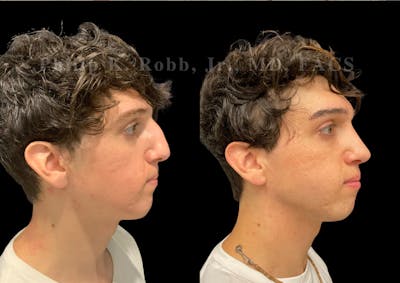 Ultrasonic Rhinoplasty Before & After Gallery - Patient 230223 - Image 1