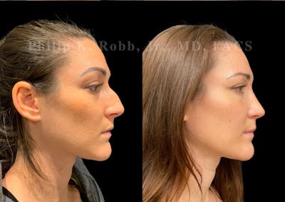 Ultrasonic Rhinoplasty Before & After Gallery - Patient 240916 - Image 1