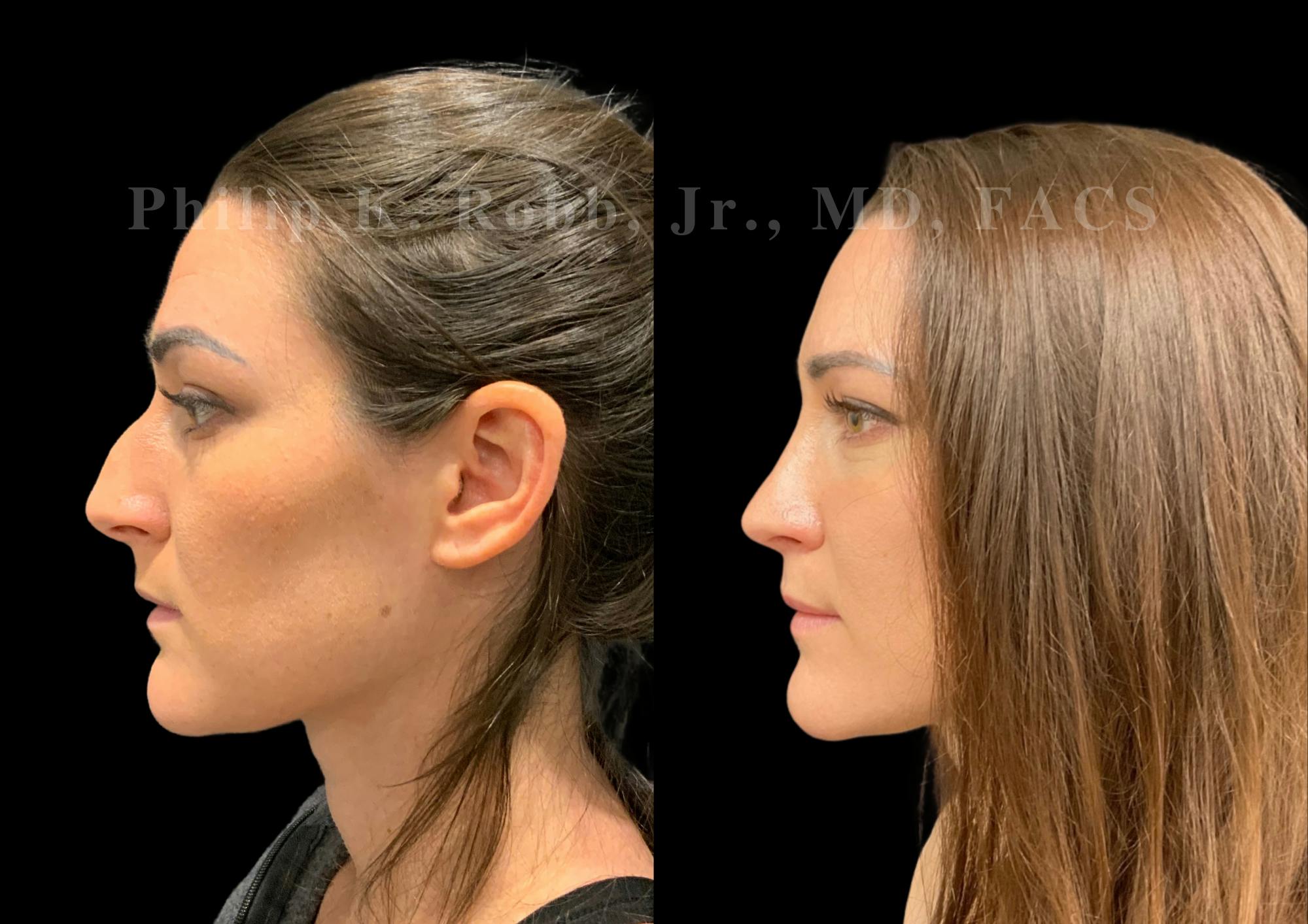 Ultrasonic Rhinoplasty Before & After Gallery - Patient 240916 - Image 5