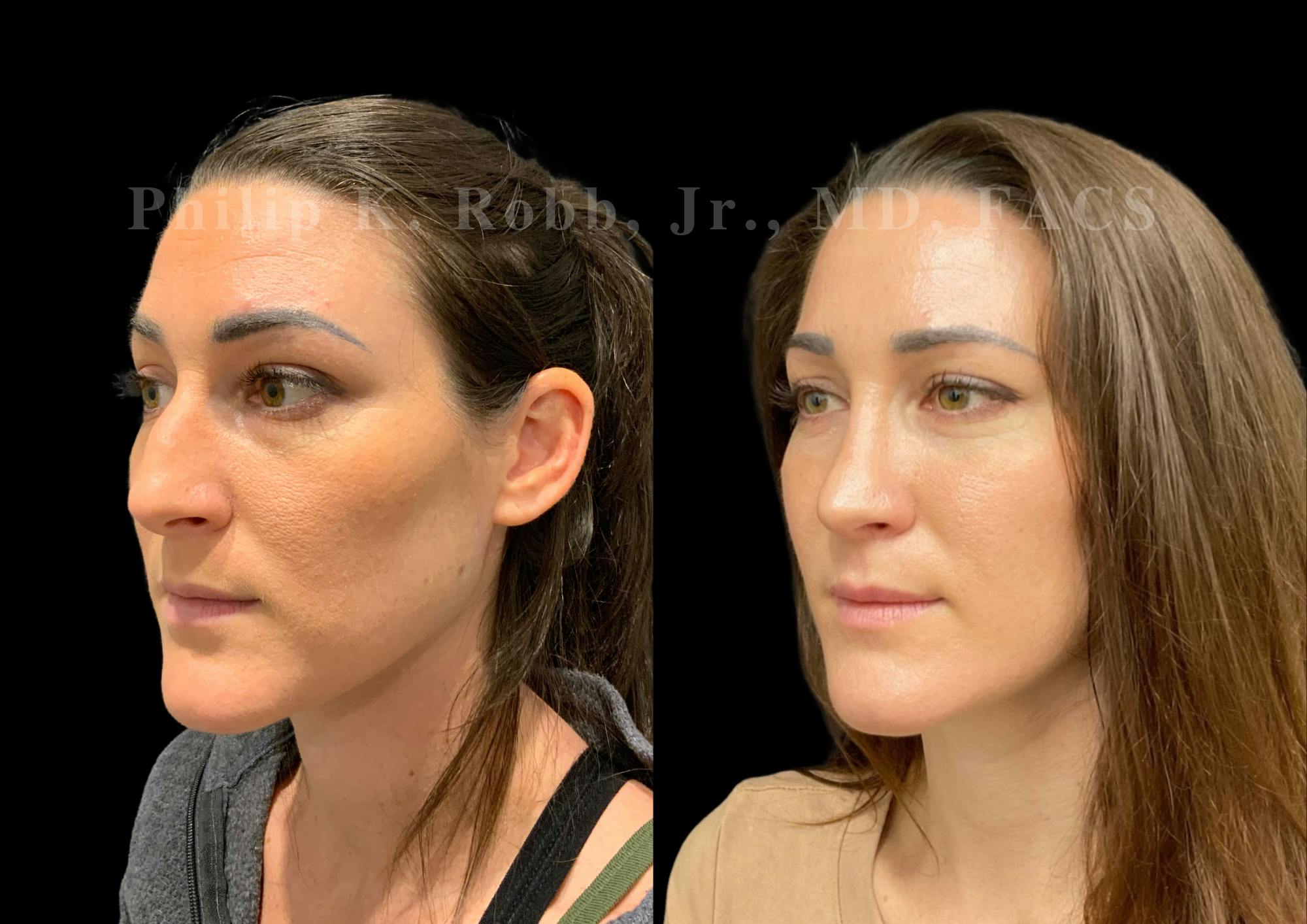 Ultrasonic Rhinoplasty Before & After Gallery - Patient 240916 - Image 4
