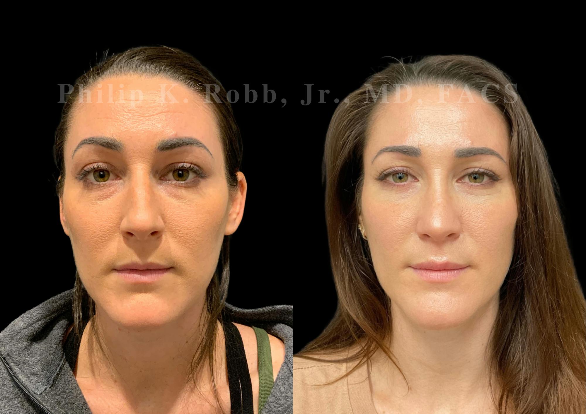 Ultrasonic Rhinoplasty Before & After Gallery - Patient 240916 - Image 3