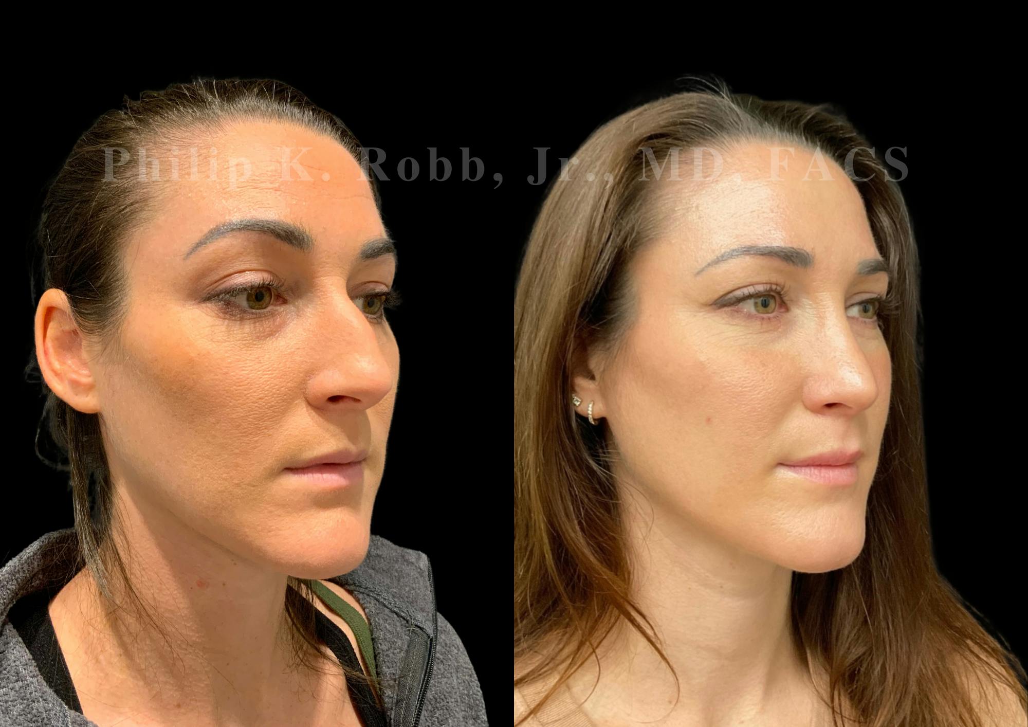 Ultrasonic Rhinoplasty Before & After Gallery - Patient 240916 - Image 2