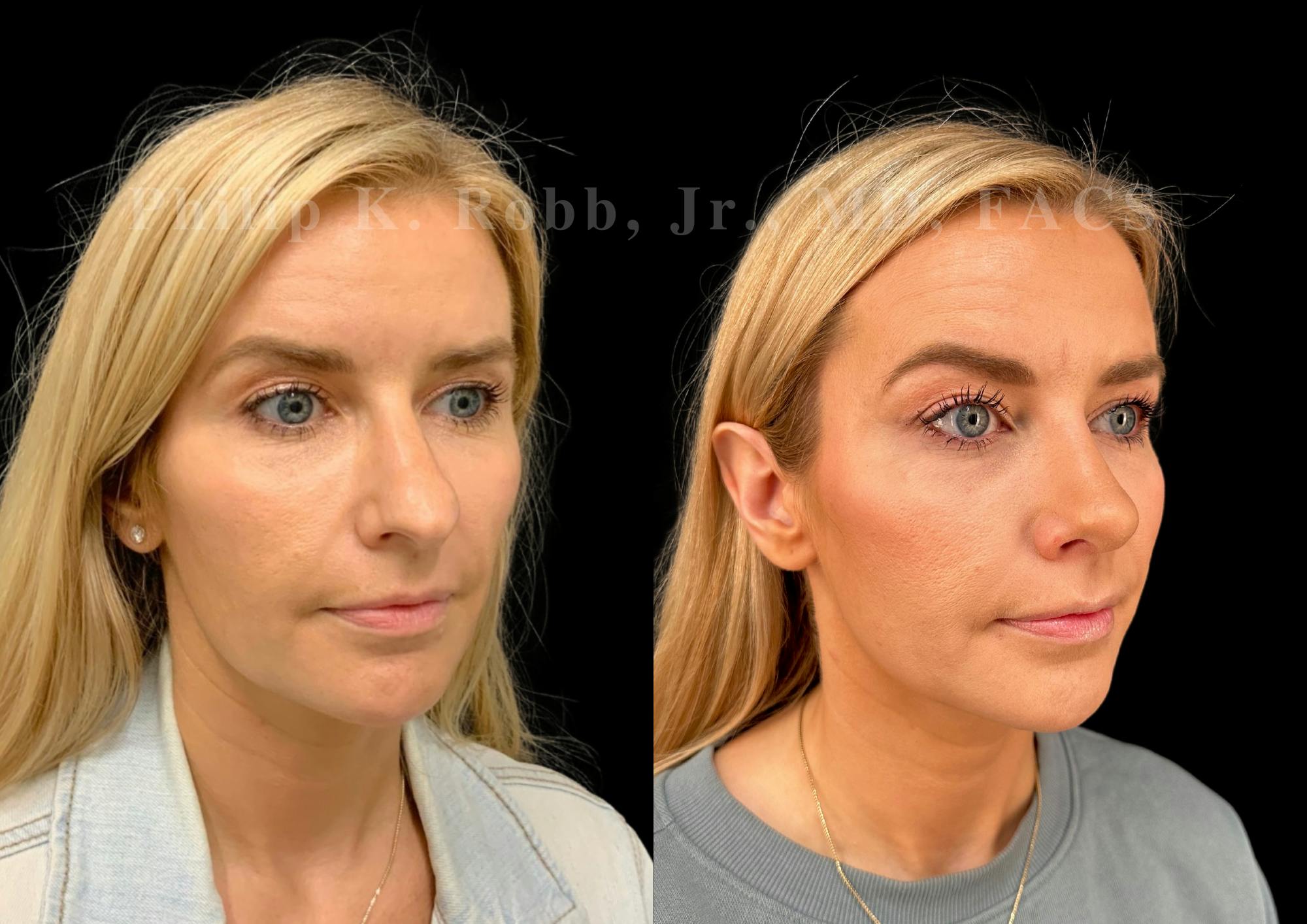 Ultrasonic Rhinoplasty Before & After Gallery - Patient 345844 - Image 2