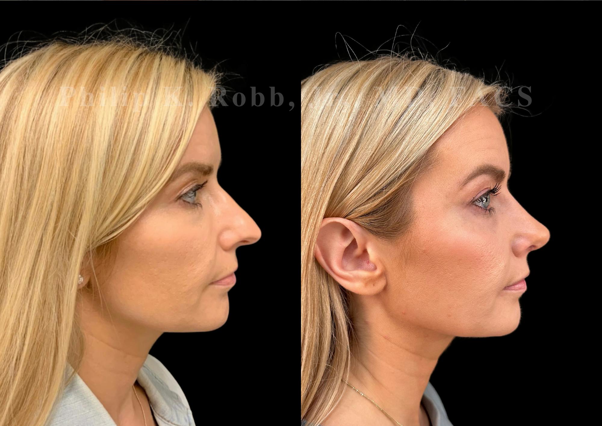 Ultrasonic Rhinoplasty Before & After Gallery - Patient 345844 - Image 1