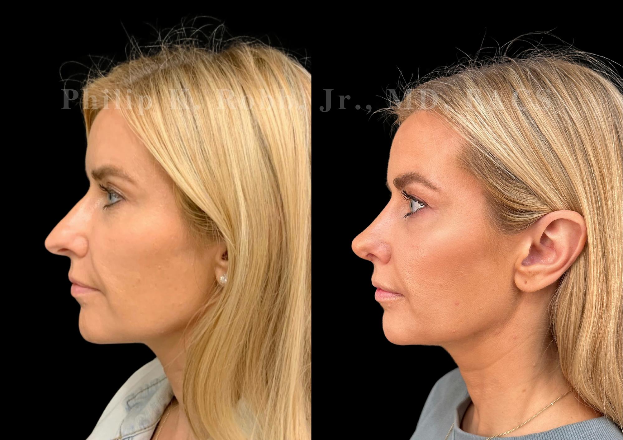 Ultrasonic Rhinoplasty Before & After Gallery - Patient 345844 - Image 5