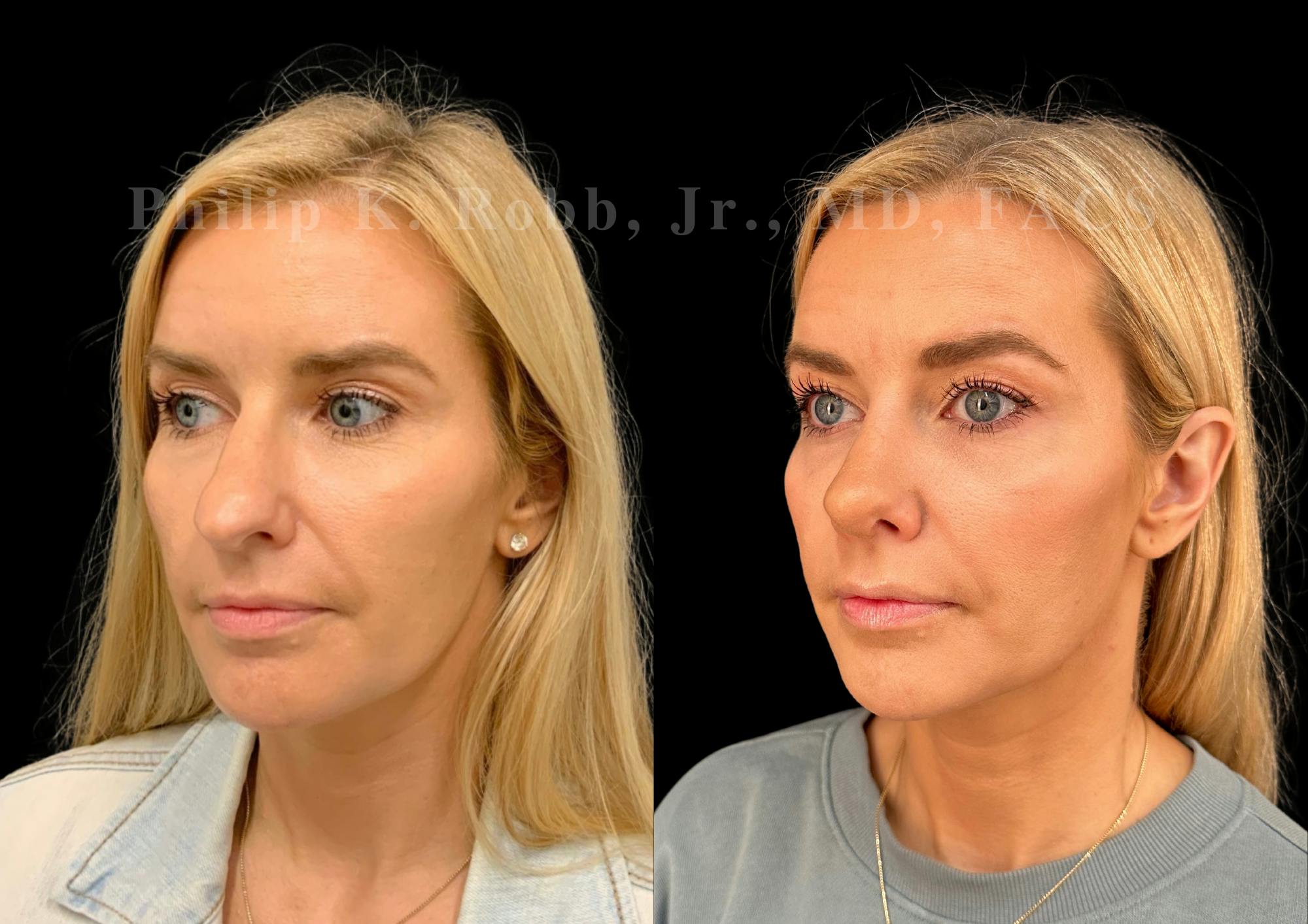 Ultrasonic Rhinoplasty Before & After Gallery - Patient 345844 - Image 4