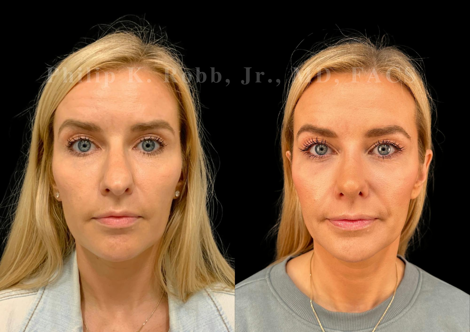Ultrasonic Rhinoplasty Before & After Gallery - Patient 345844 - Image 3