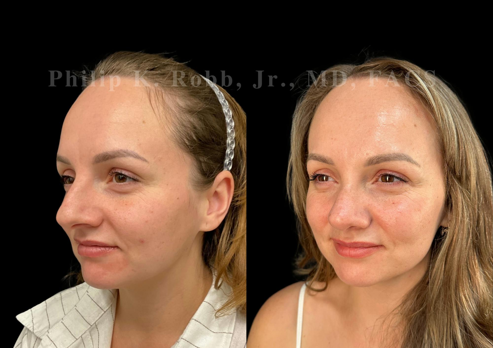 Ultrasonic Rhinoplasty Before & After Gallery - Patient 102550 - Image 4