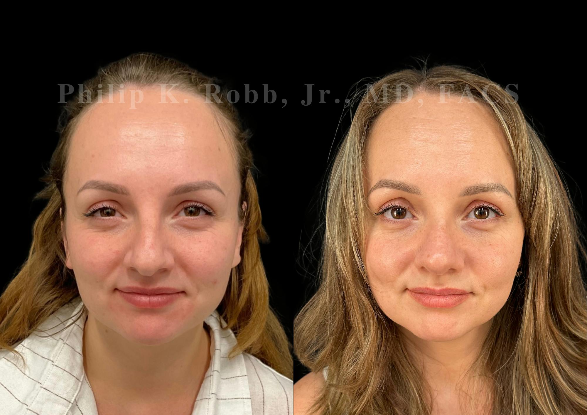 Ultrasonic Rhinoplasty Before & After Gallery - Patient 102550 - Image 3
