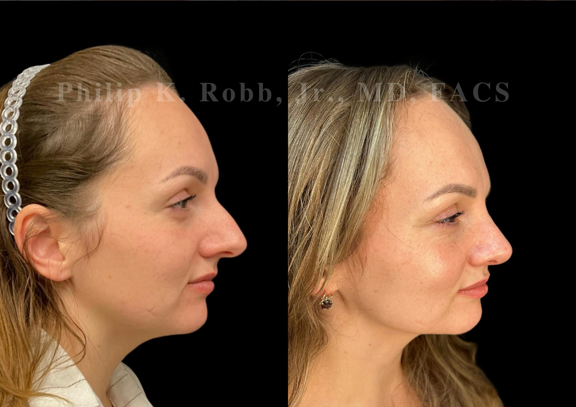 Ultrasonic Rhinoplasty Before & After Gallery - Patient 102550 - Image 1
