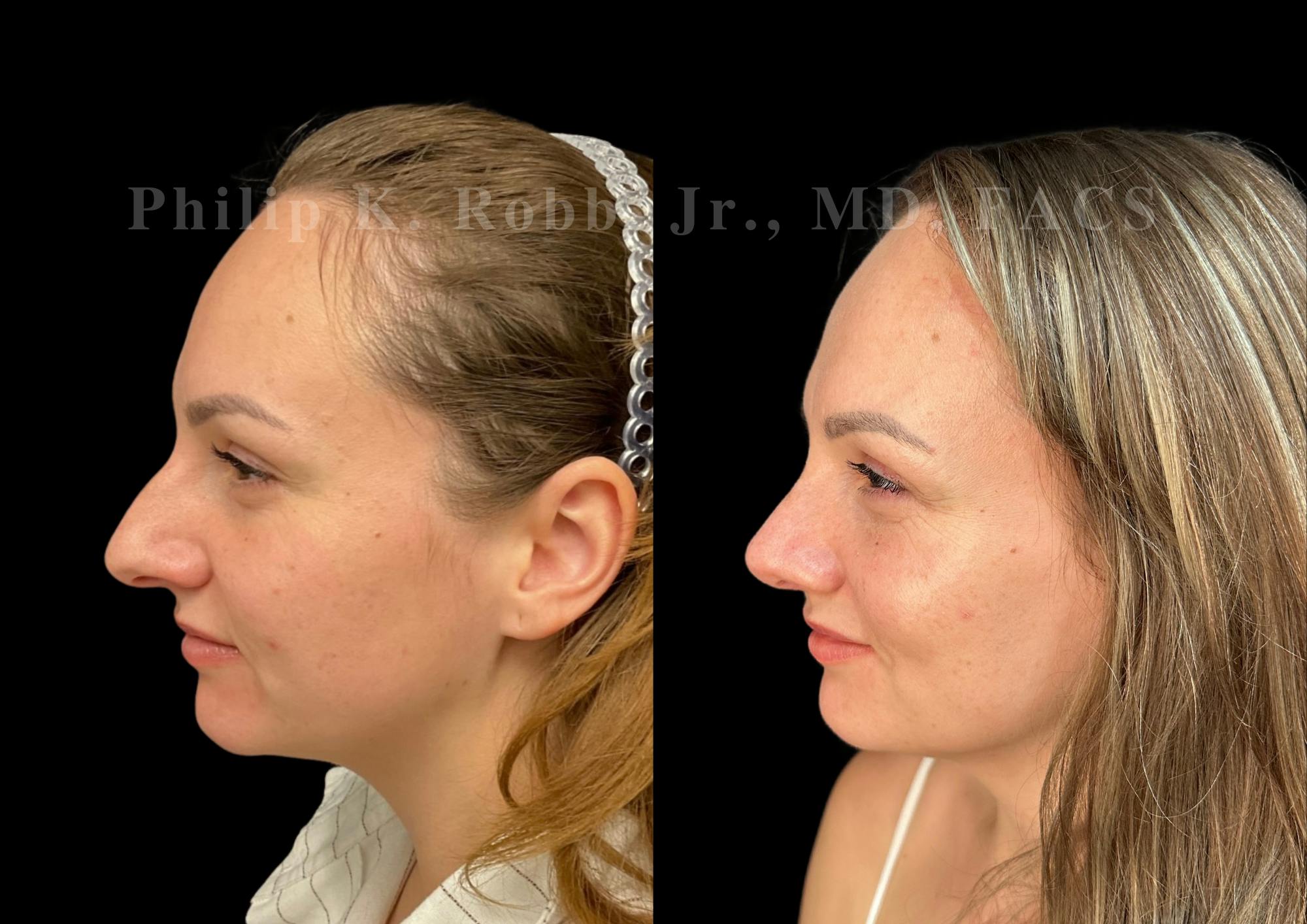 Ultrasonic Rhinoplasty Before & After Gallery - Patient 102550 - Image 5