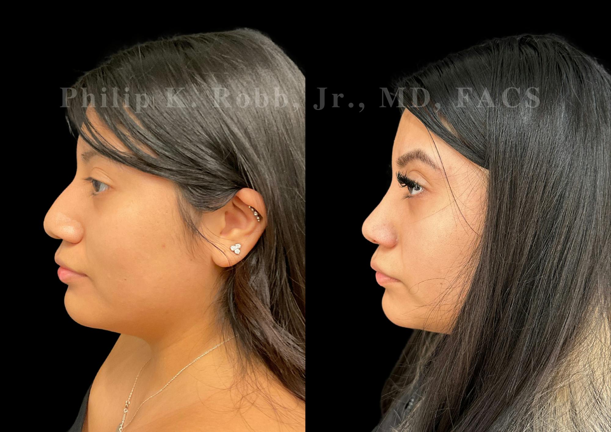 Ultrasonic Rhinoplasty Before & After Gallery - Patient 375252 - Image 5