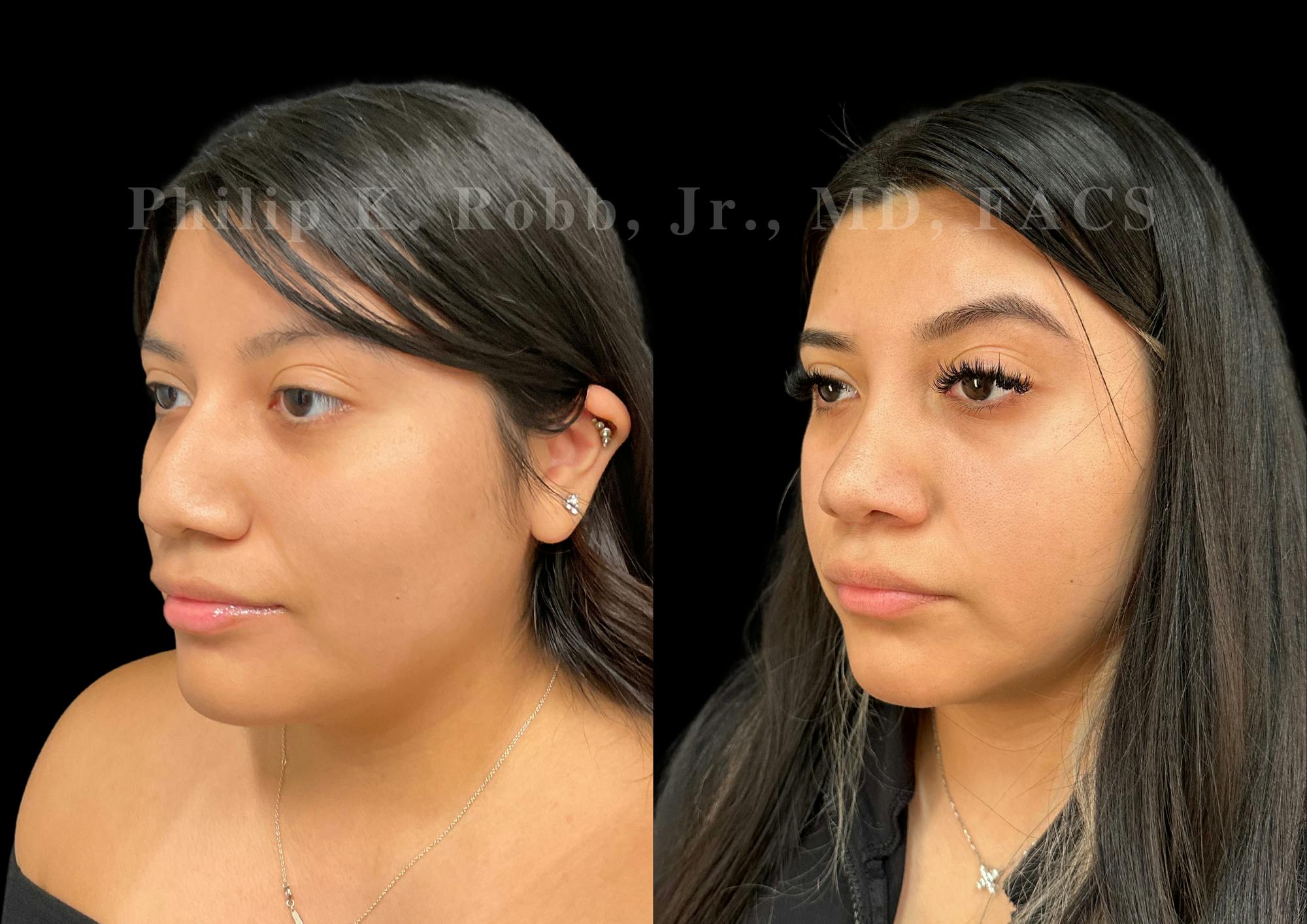 Ultrasonic Rhinoplasty Before & After Gallery - Patient 375252 - Image 4