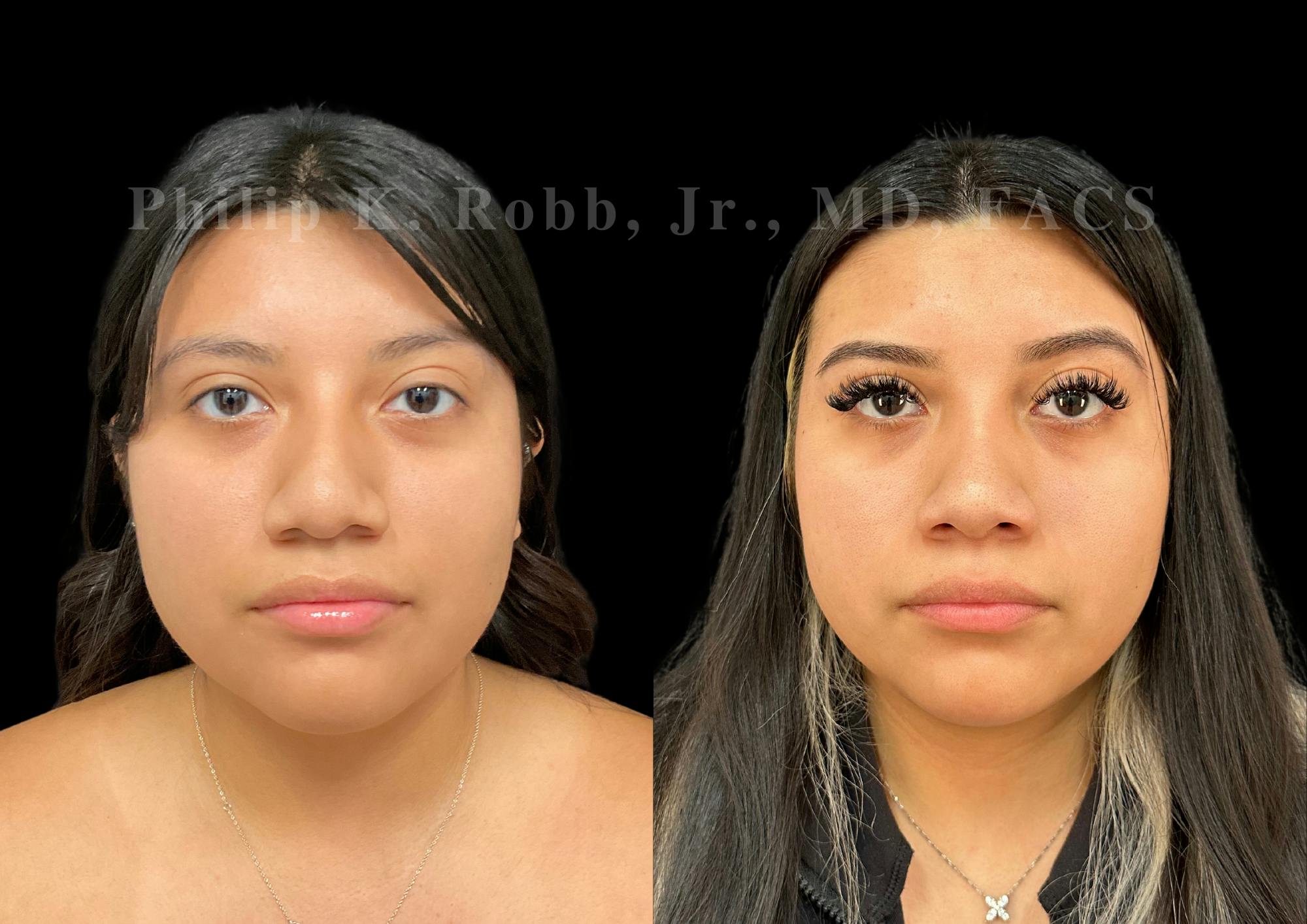 Ultrasonic Rhinoplasty Before & After Gallery - Patient 375252 - Image 3