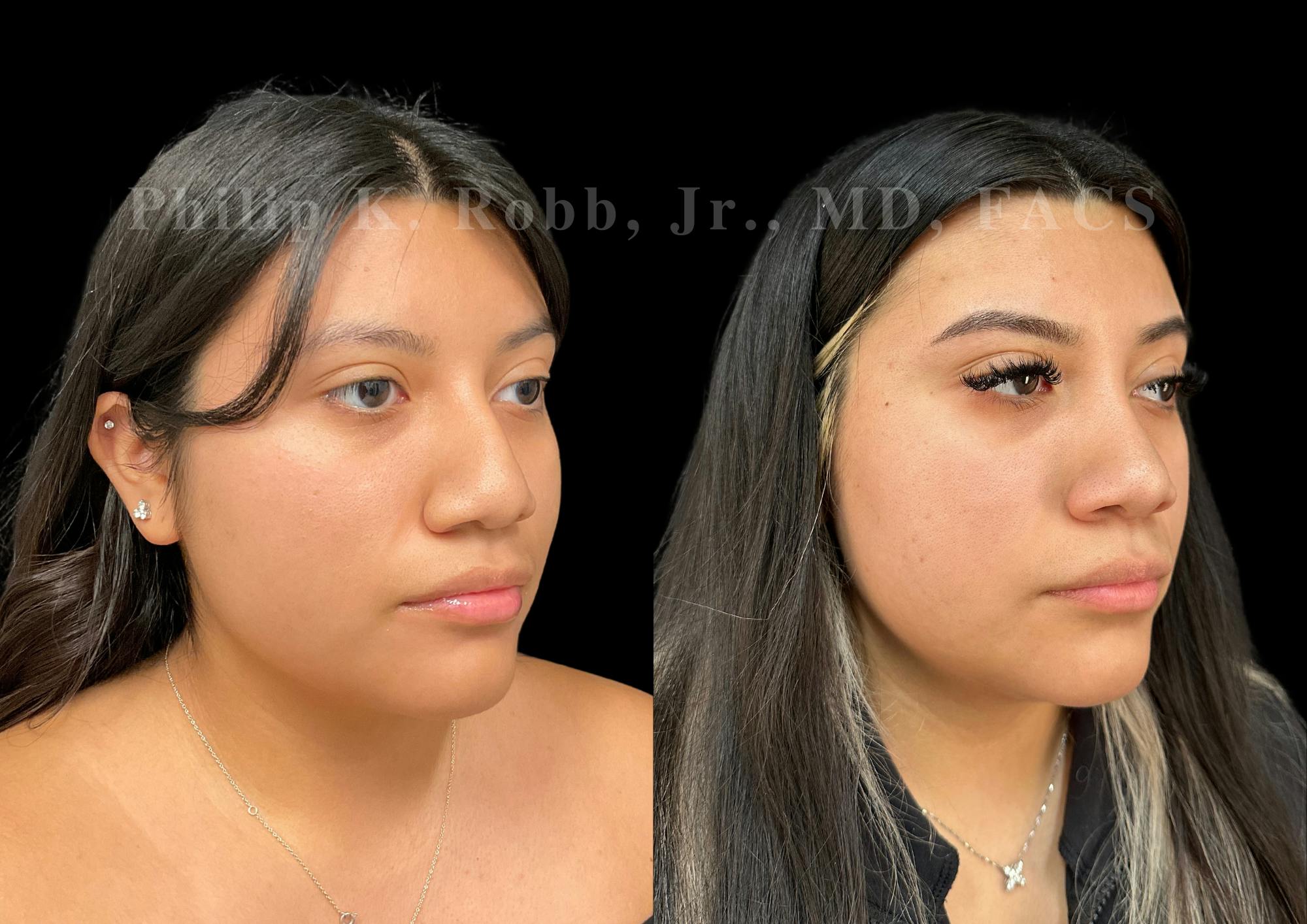 Ultrasonic Rhinoplasty Before & After Gallery - Patient 375252 - Image 2