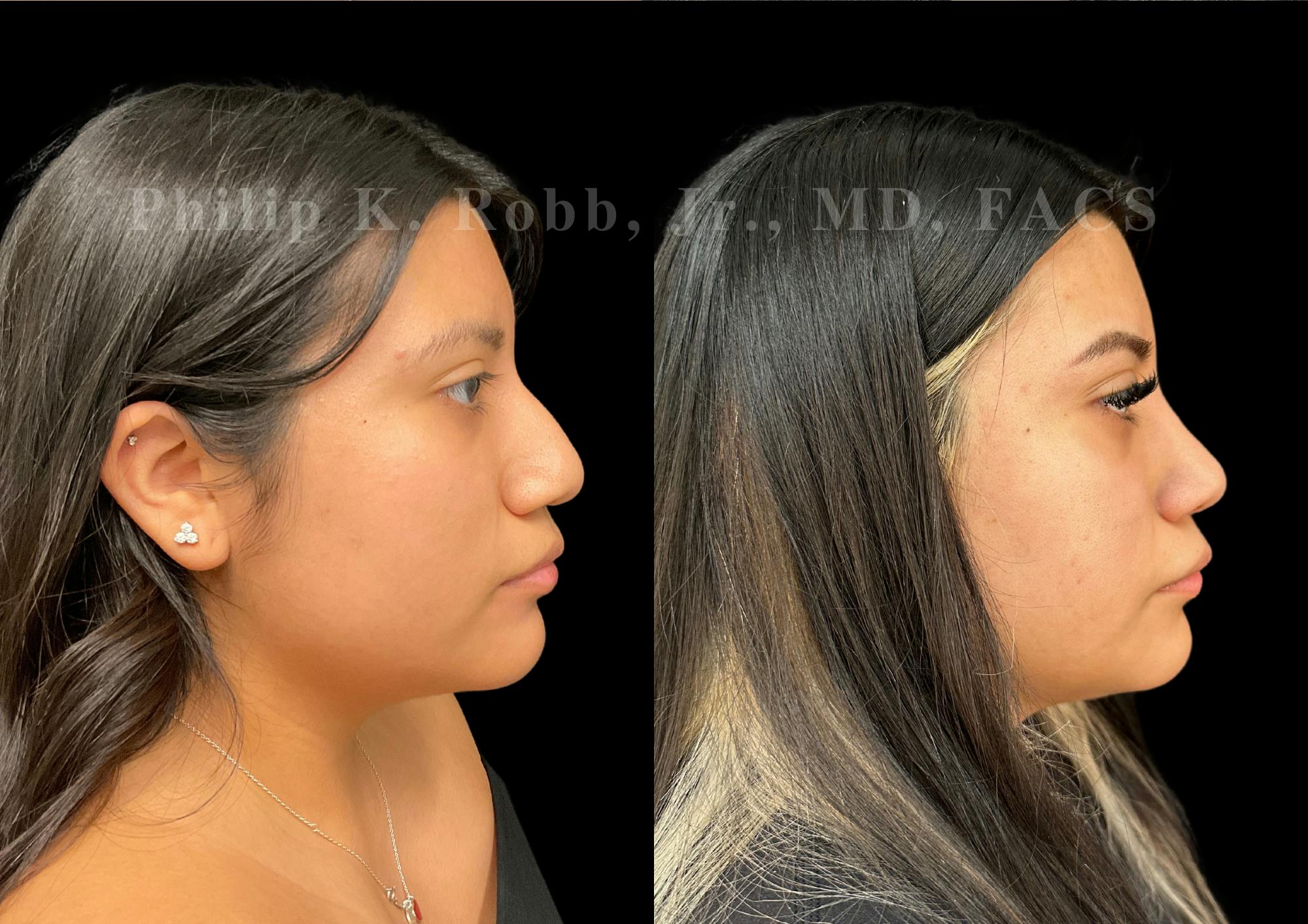 Ultrasonic Rhinoplasty Before & After Gallery - Patient 375252 - Image 1