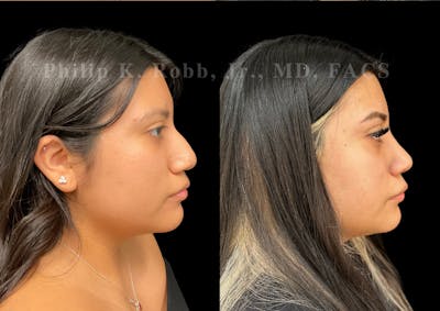 Ultrasonic Rhinoplasty Before & After Gallery - Patient 375252 - Image 1
