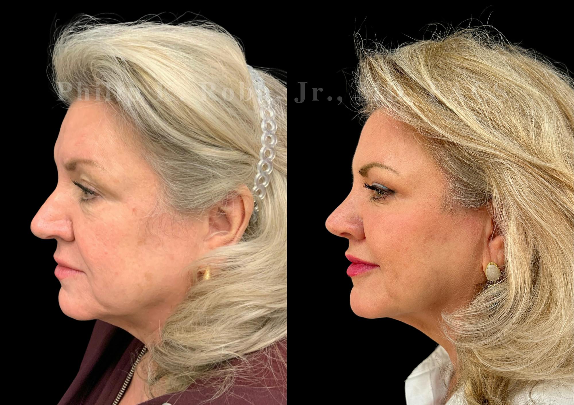 Upper Blepharoplasty Before & After Gallery - Patient 369227 - Image 3
