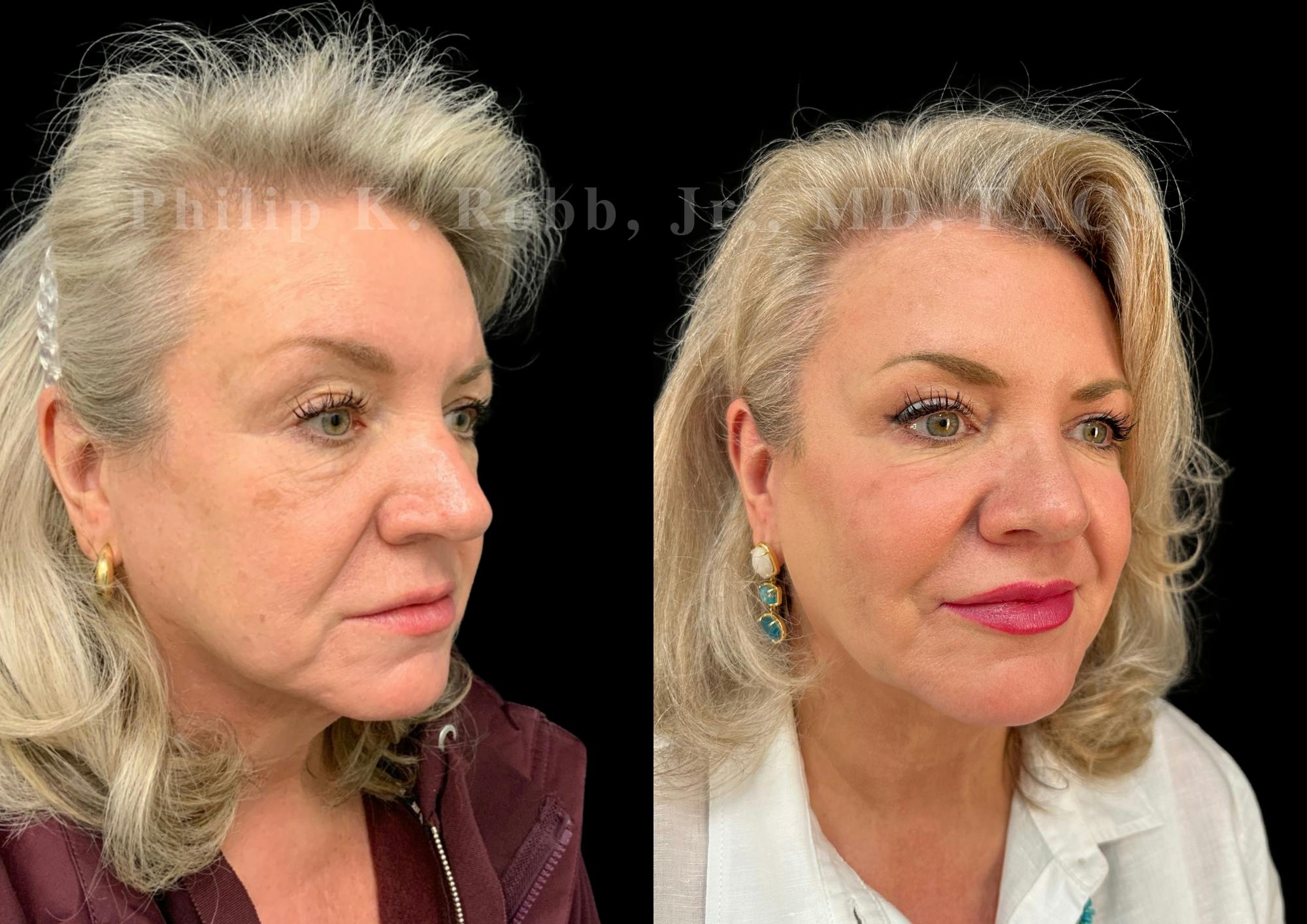Upper Blepharoplasty Before & After Gallery - Patient 369227 - Image 4