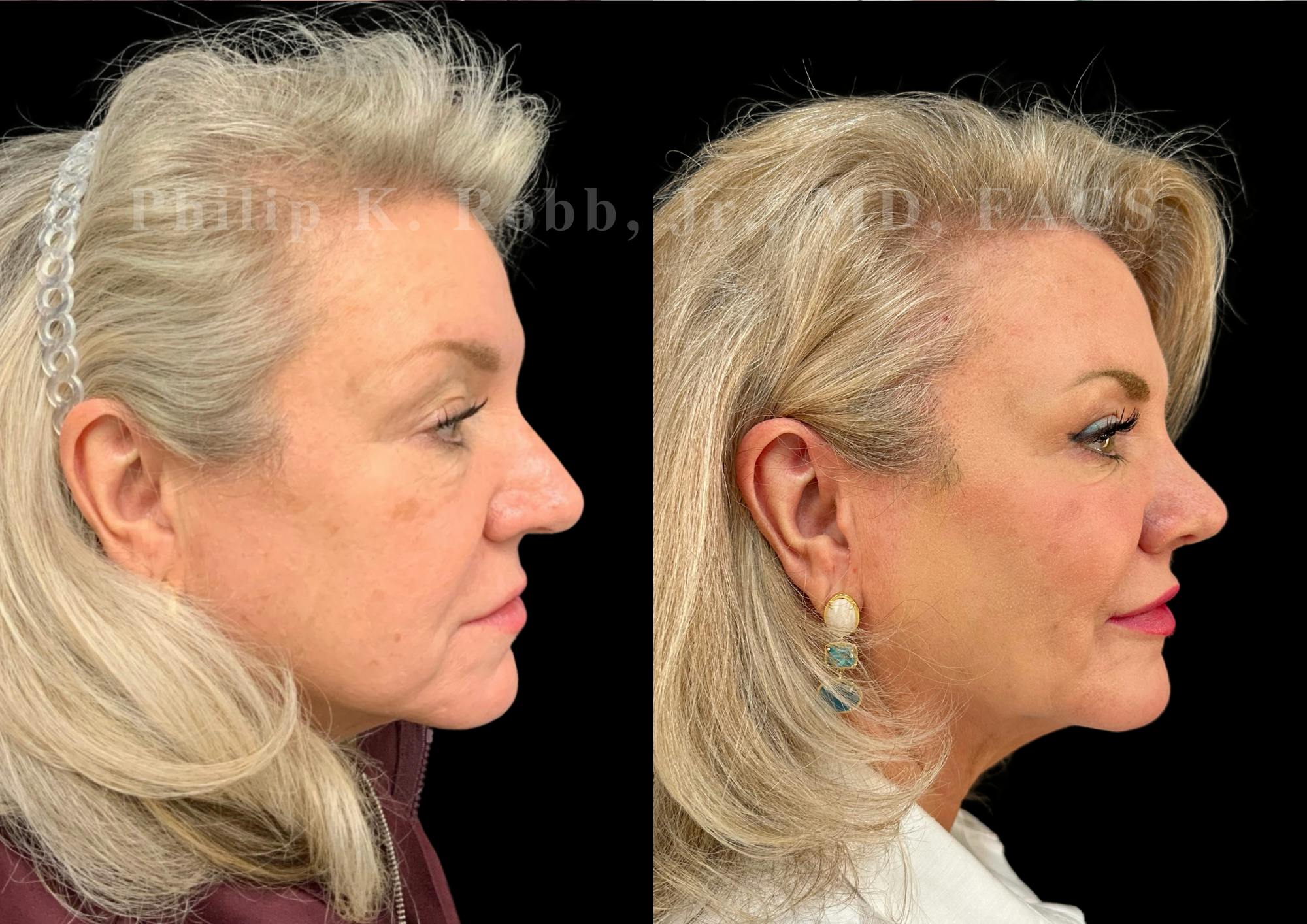 Upper Blepharoplasty Before & After Gallery - Patient 369227 - Image 5