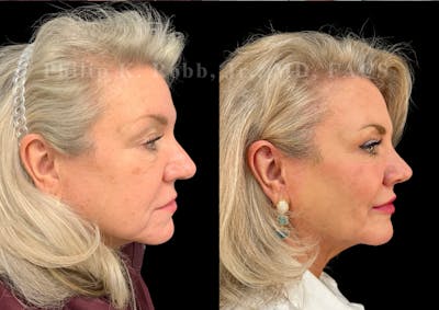 Ultrasonic Rhinoplasty Before & After Gallery - Patient 272770 - Image 1