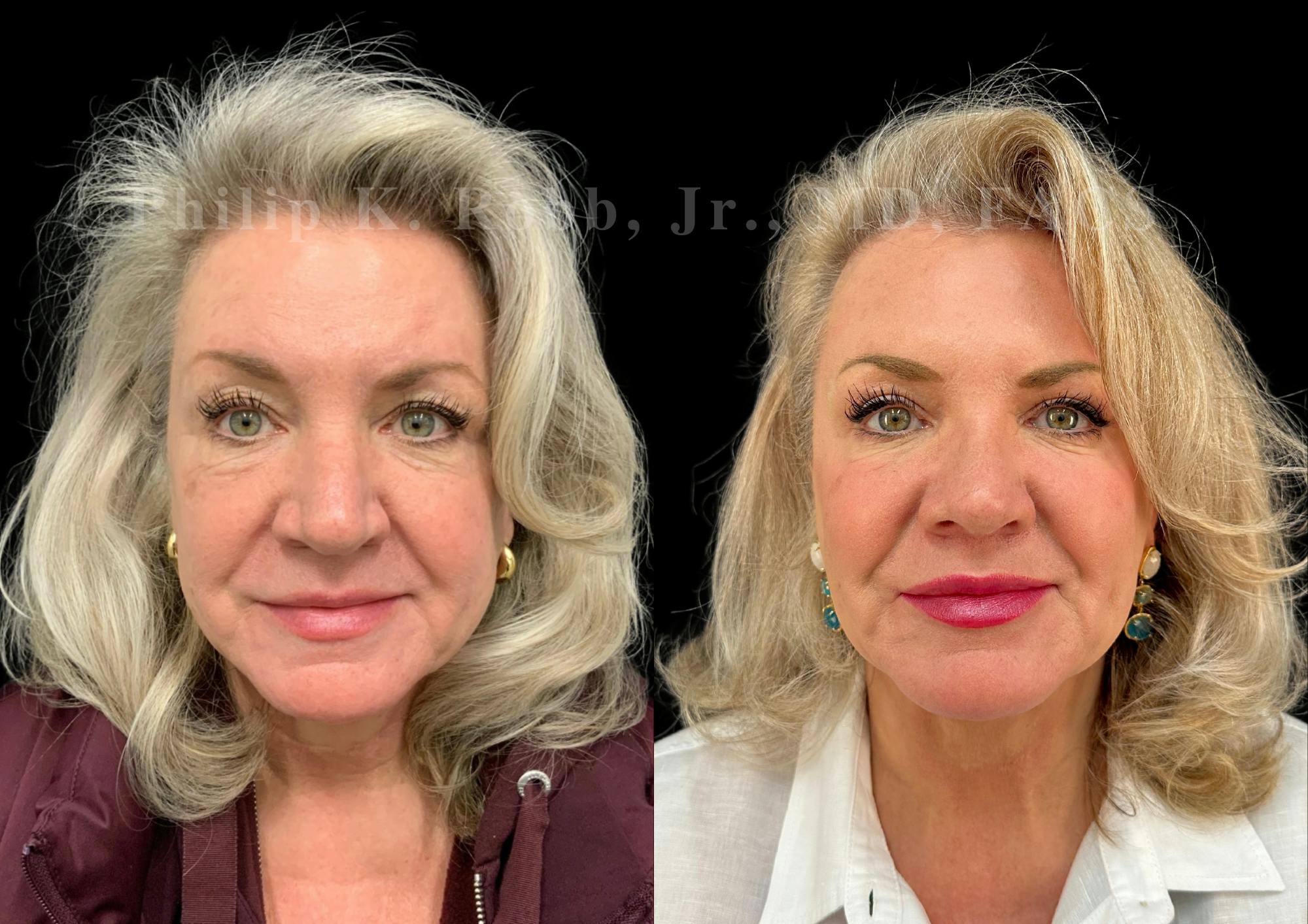 Upper Blepharoplasty Before & After Gallery - Patient 369227 - Image 1