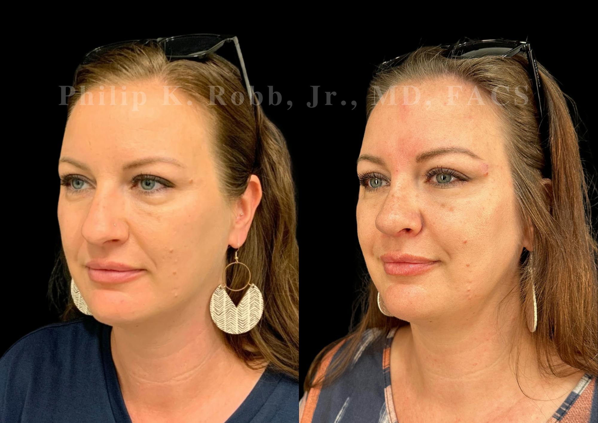 Ultrasonic Rhinoplasty Before & After Gallery - Patient 142683 - Image 4