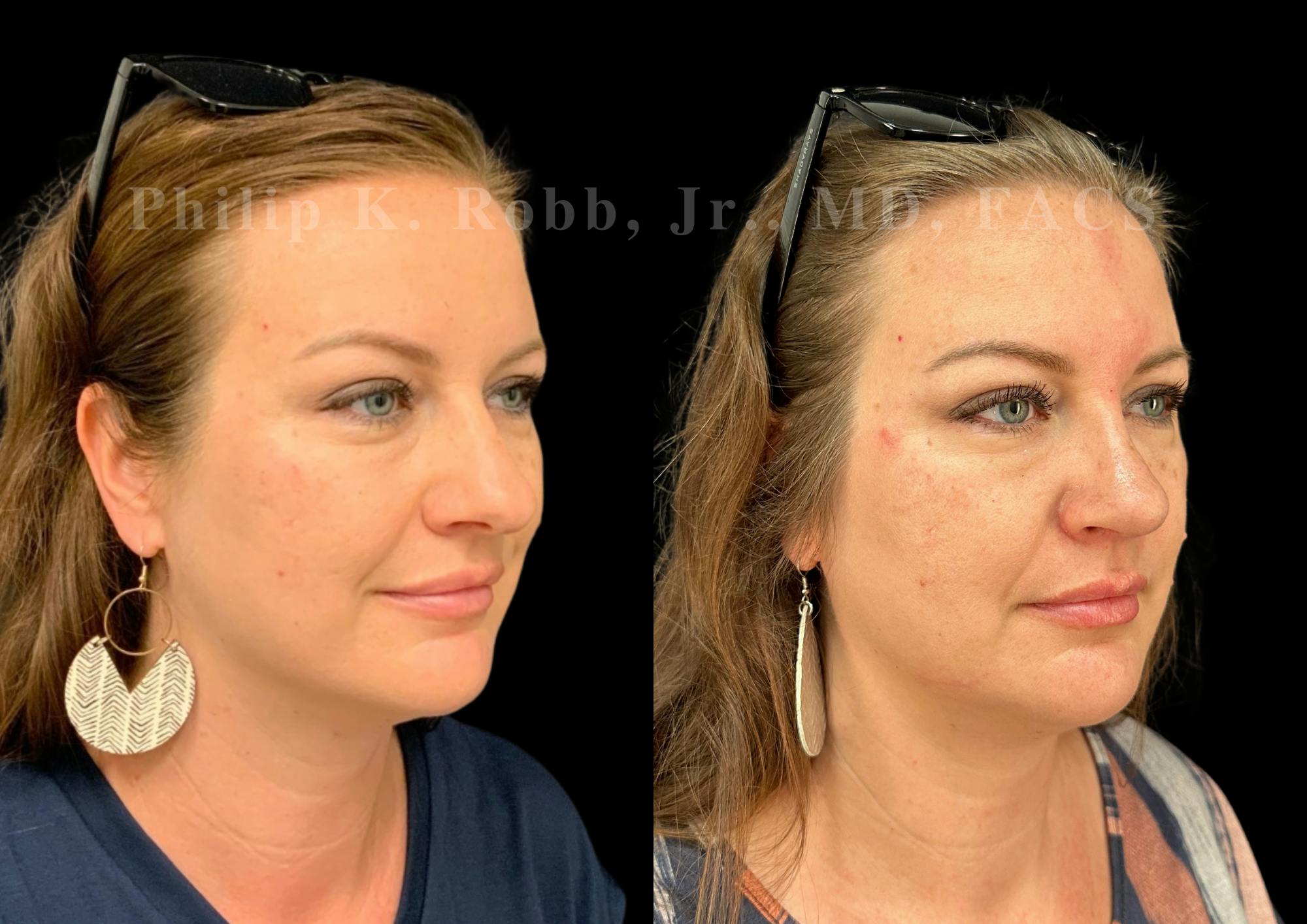Ultrasonic Rhinoplasty Before & After Gallery - Patient 142683 - Image 2