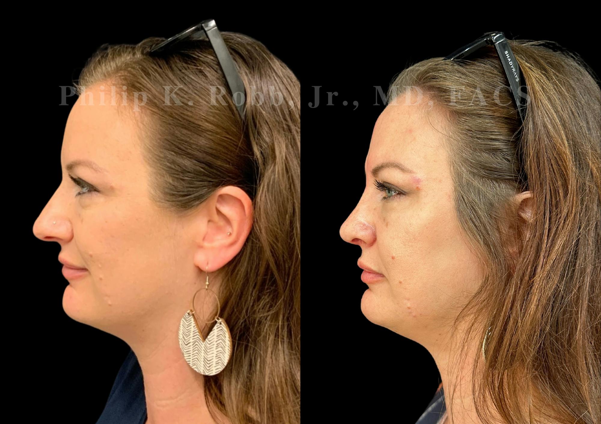 Ultrasonic Rhinoplasty Before & After Gallery - Patient 142683 - Image 5