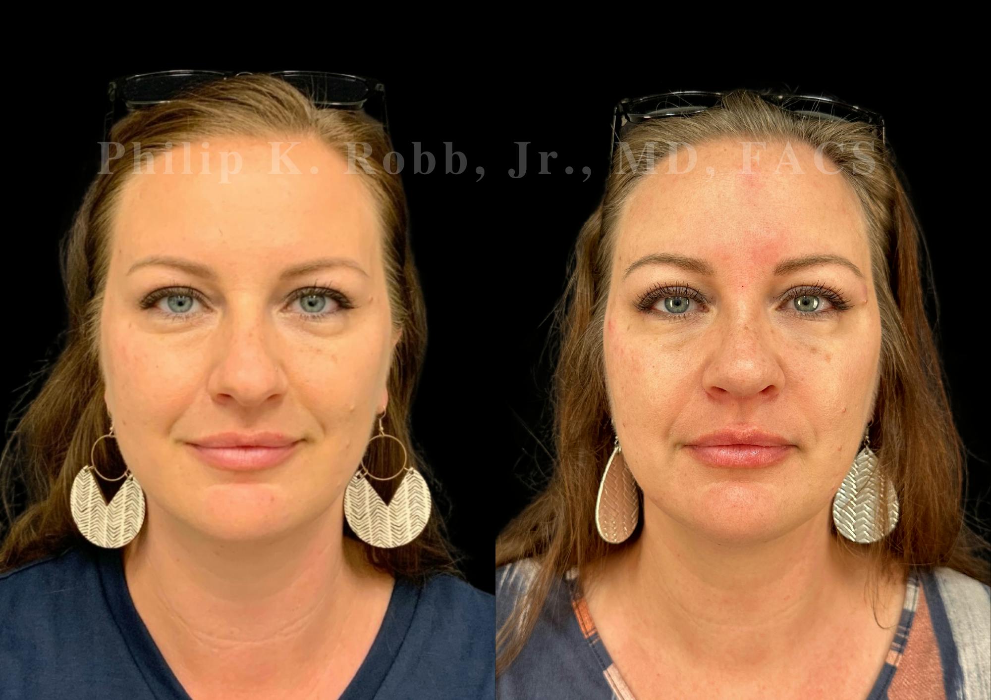 Ultrasonic Rhinoplasty Before & After Gallery - Patient 142683 - Image 3