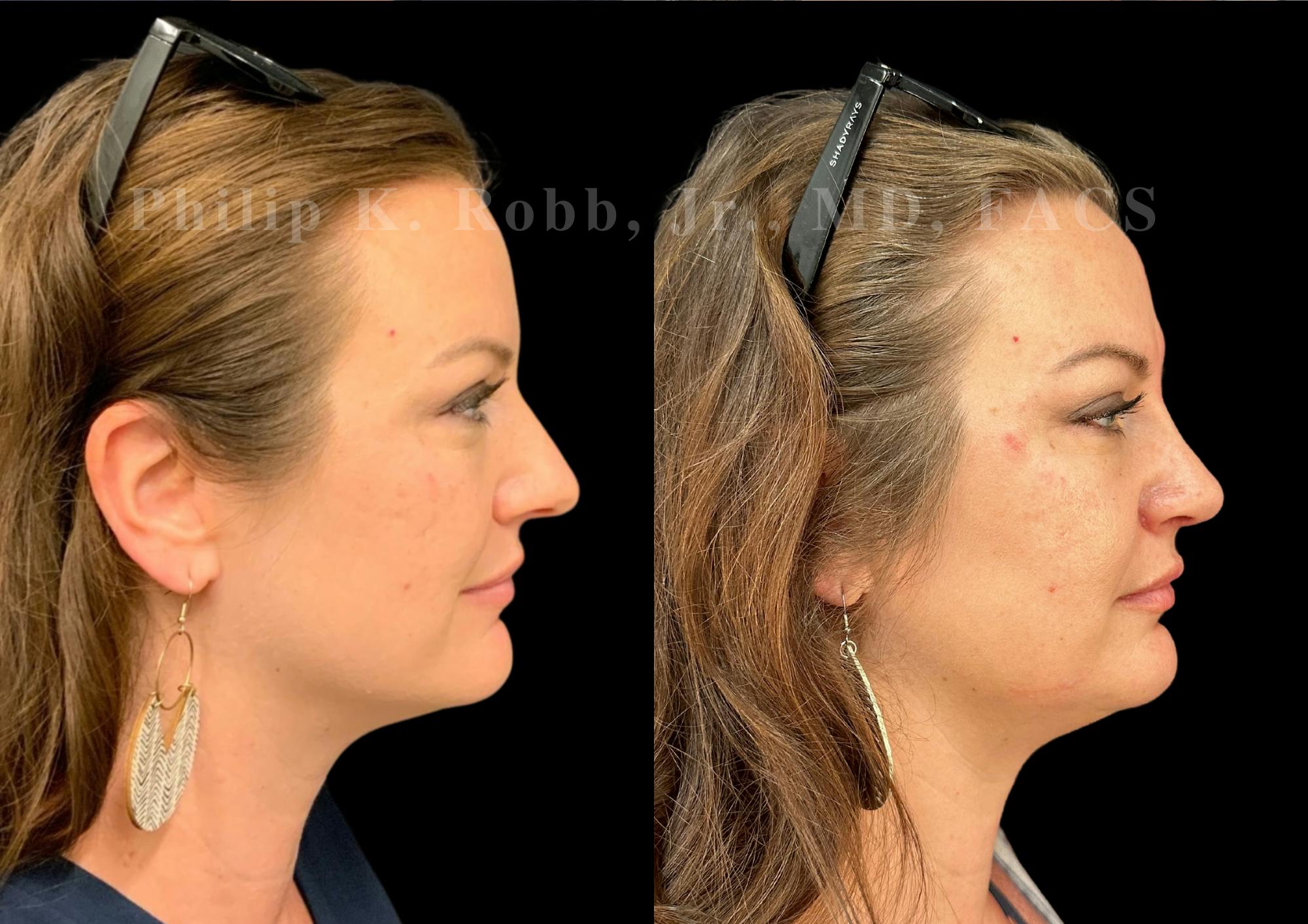 Ultrasonic Rhinoplasty Before & After Gallery - Patient 142683 - Image 1