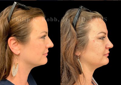Ultrasonic Rhinoplasty Before & After Gallery - Patient 142683 - Image 1