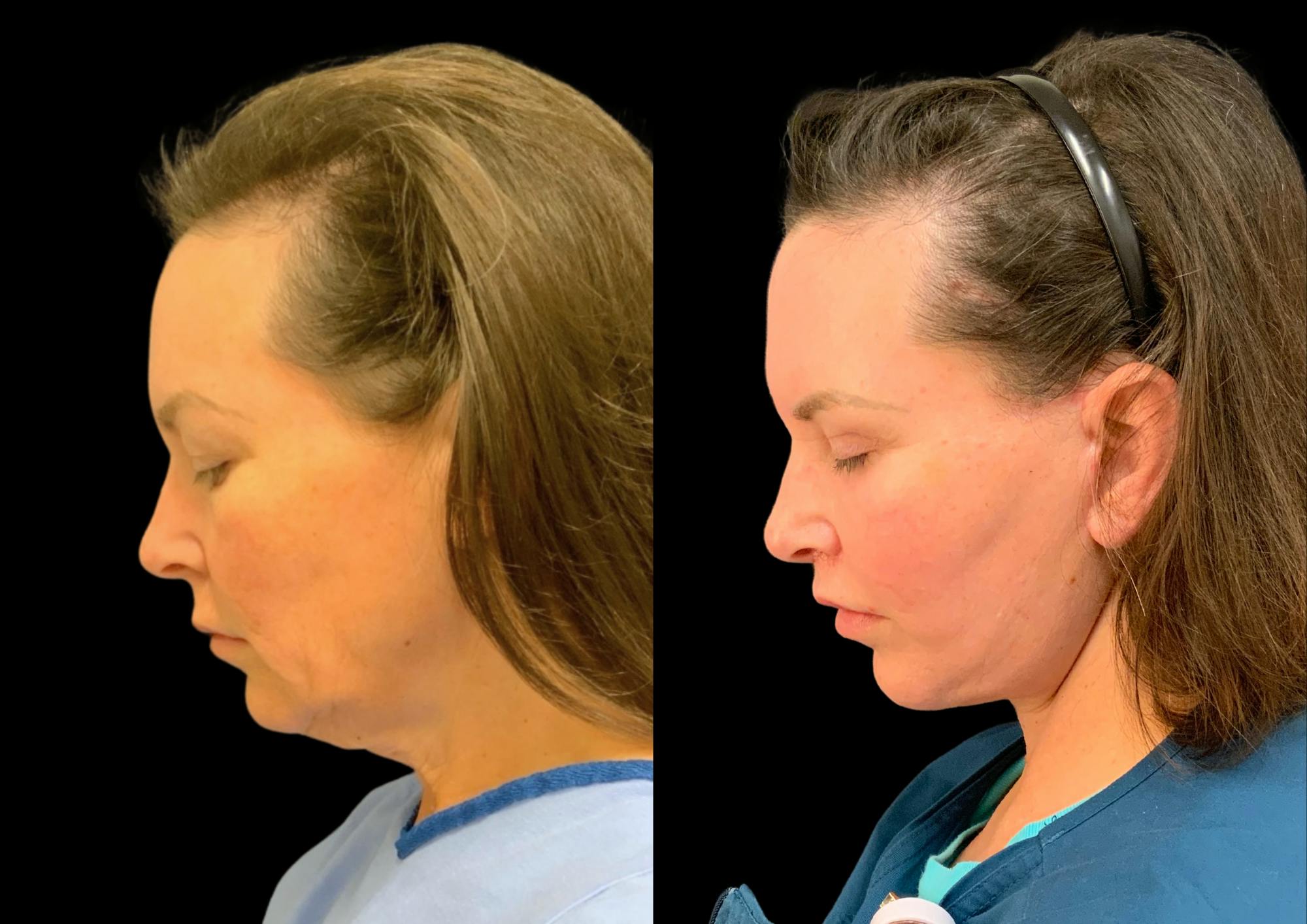 Facelift Before & After Gallery - Patient 211763 - Image 2