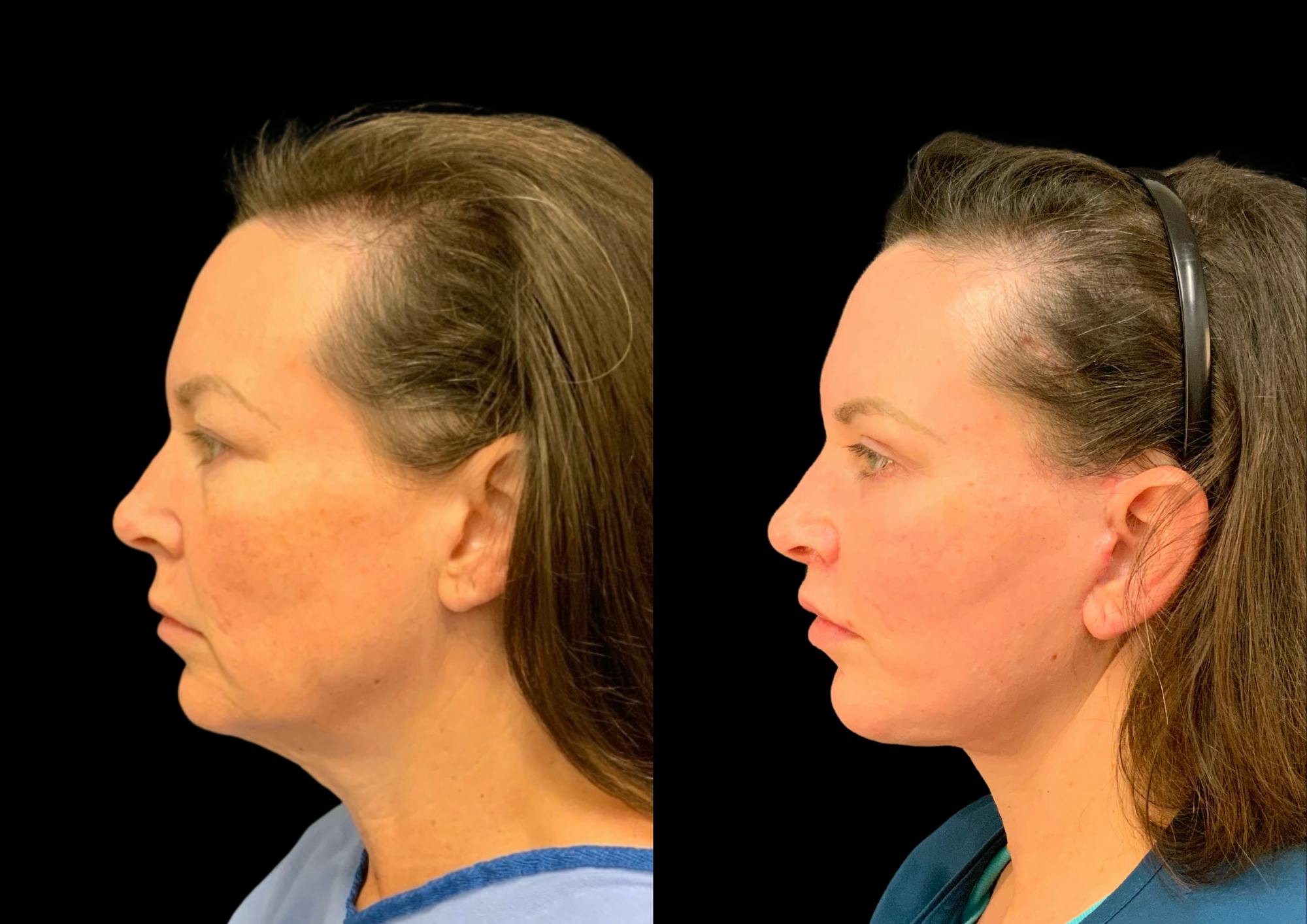Upper Blepharoplasty Before & After Gallery - Patient 378839 - Image 3