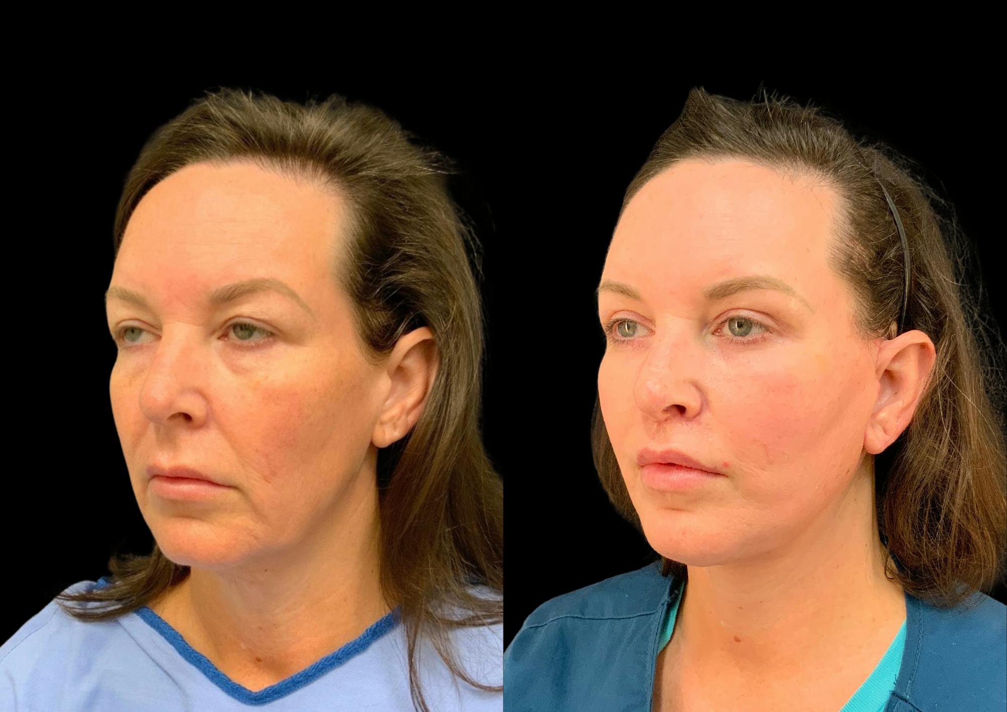Upper Blepharoplasty Before & After Gallery - Patient 378839 - Image 2