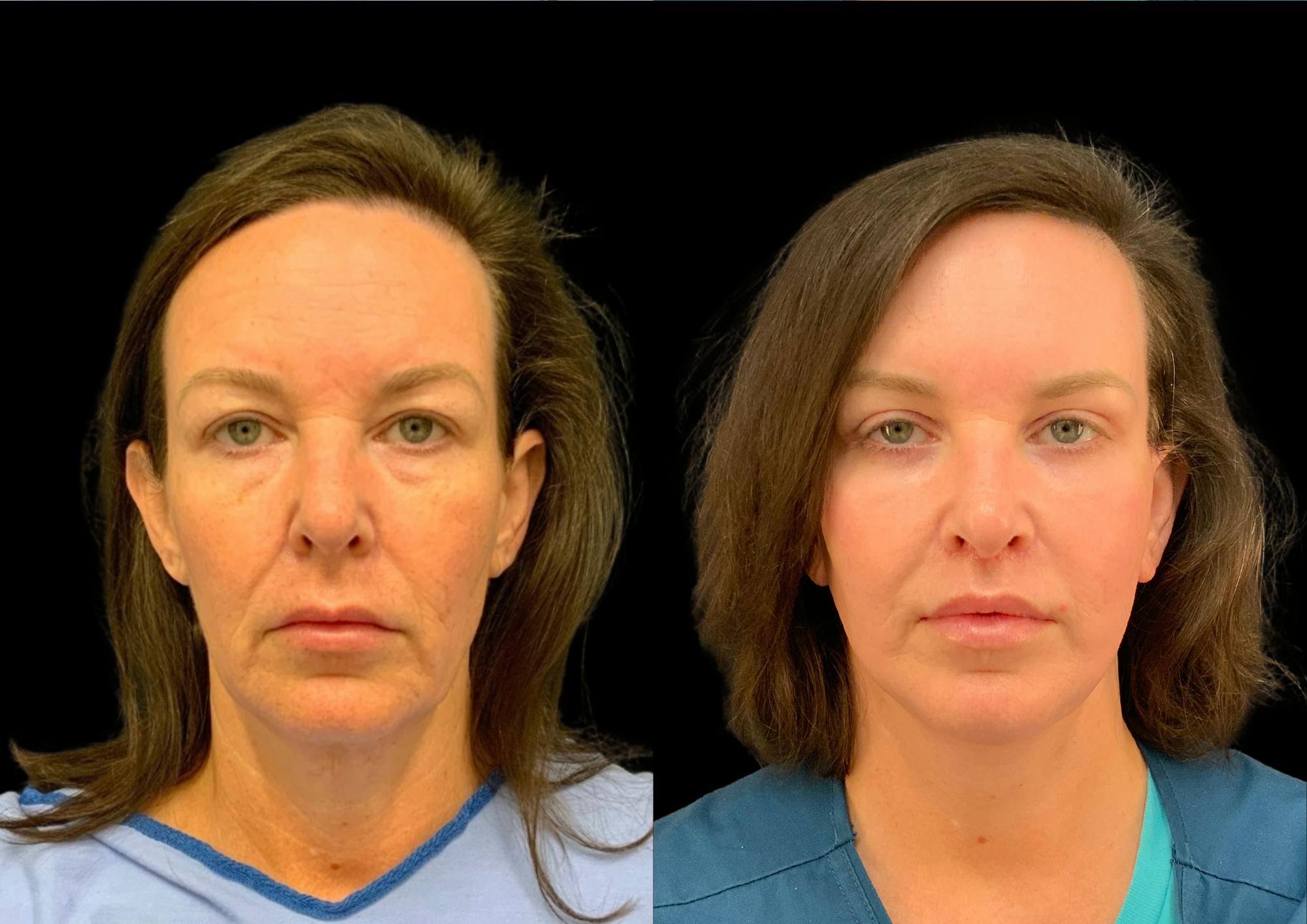 Upper Blepharoplasty Before & After Gallery - Patient 378839 - Image 1