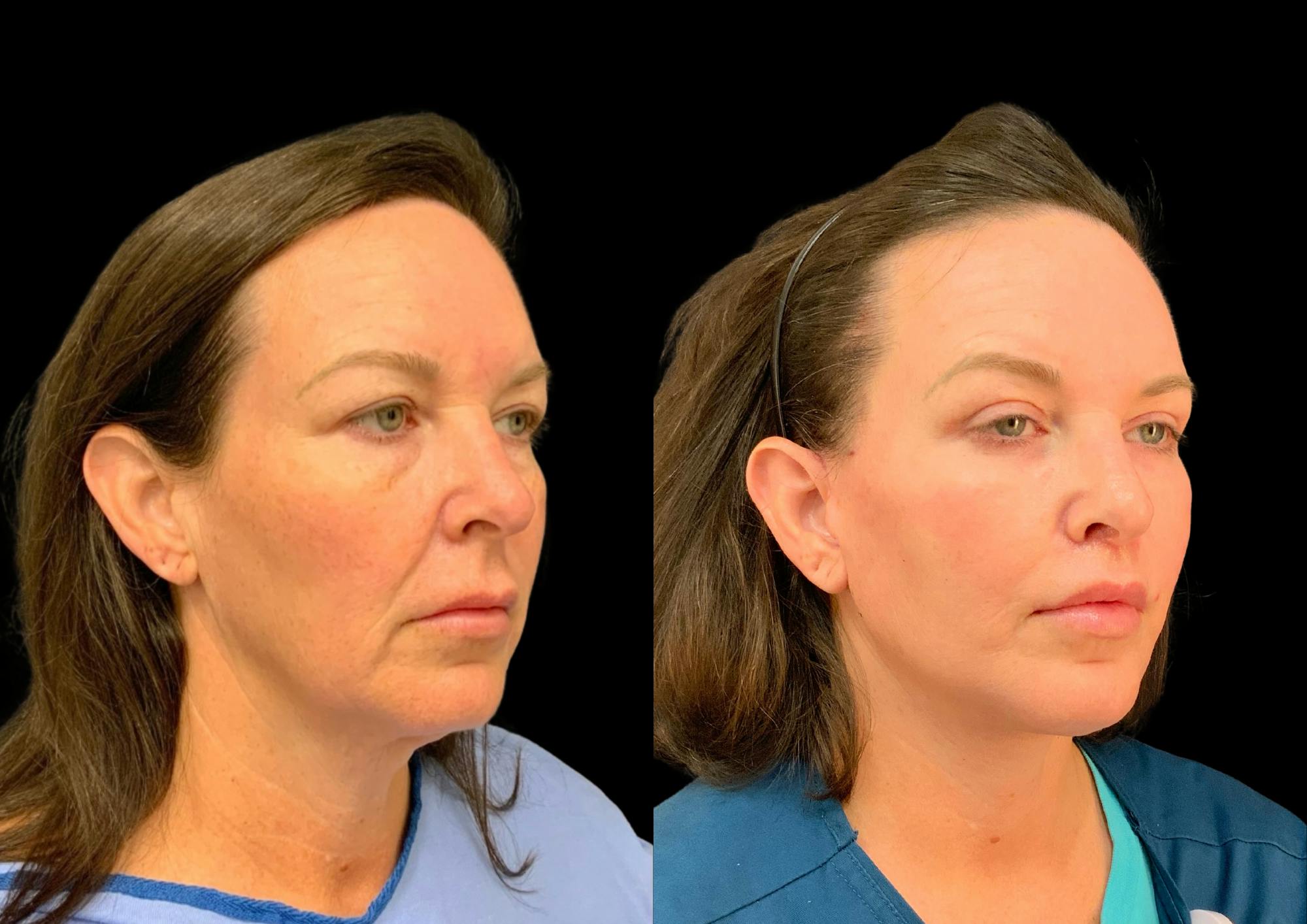 Upper Blepharoplasty Before & After Gallery - Patient 378839 - Image 4